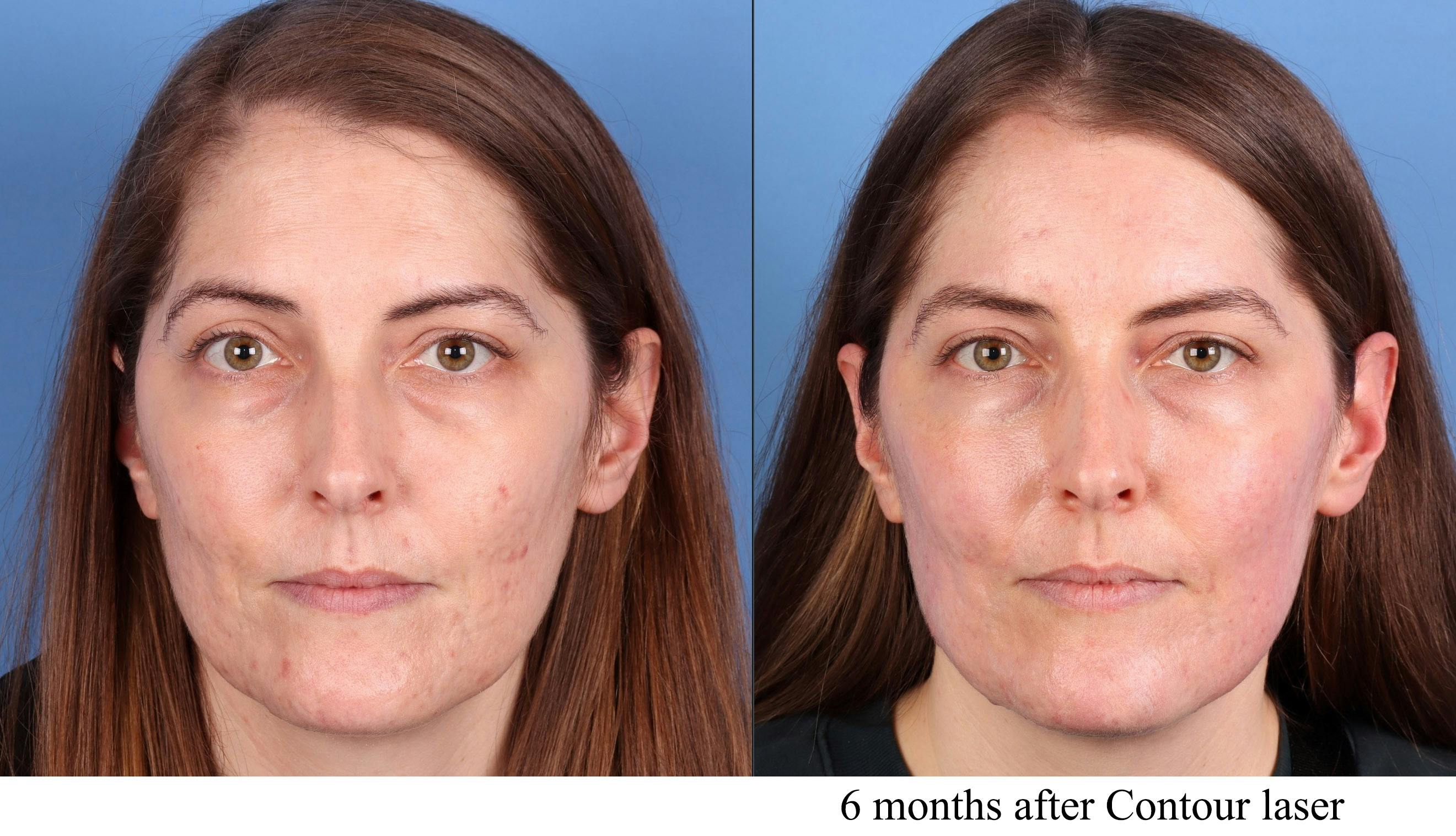 Contour TRL Laser Before & After Gallery - Patient 159824 - Image 1