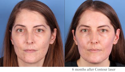 Contour TRL Laser Before & After Gallery - Patient 159824 - Image 1