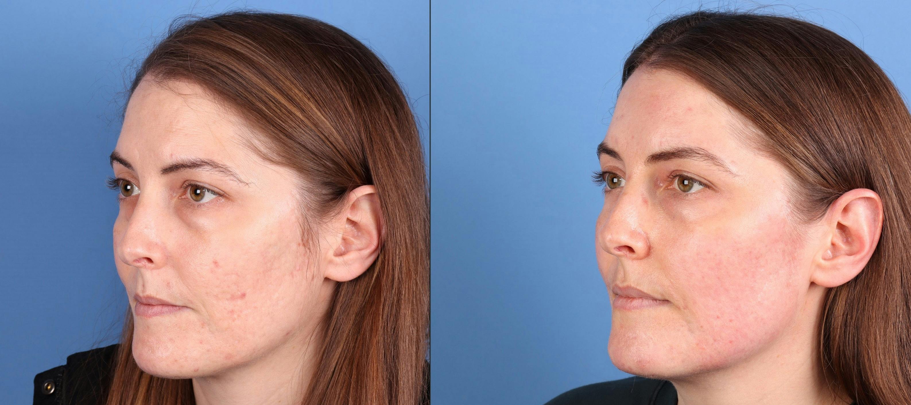 Contour TRL Laser Before & After Gallery - Patient 159824 - Image 2