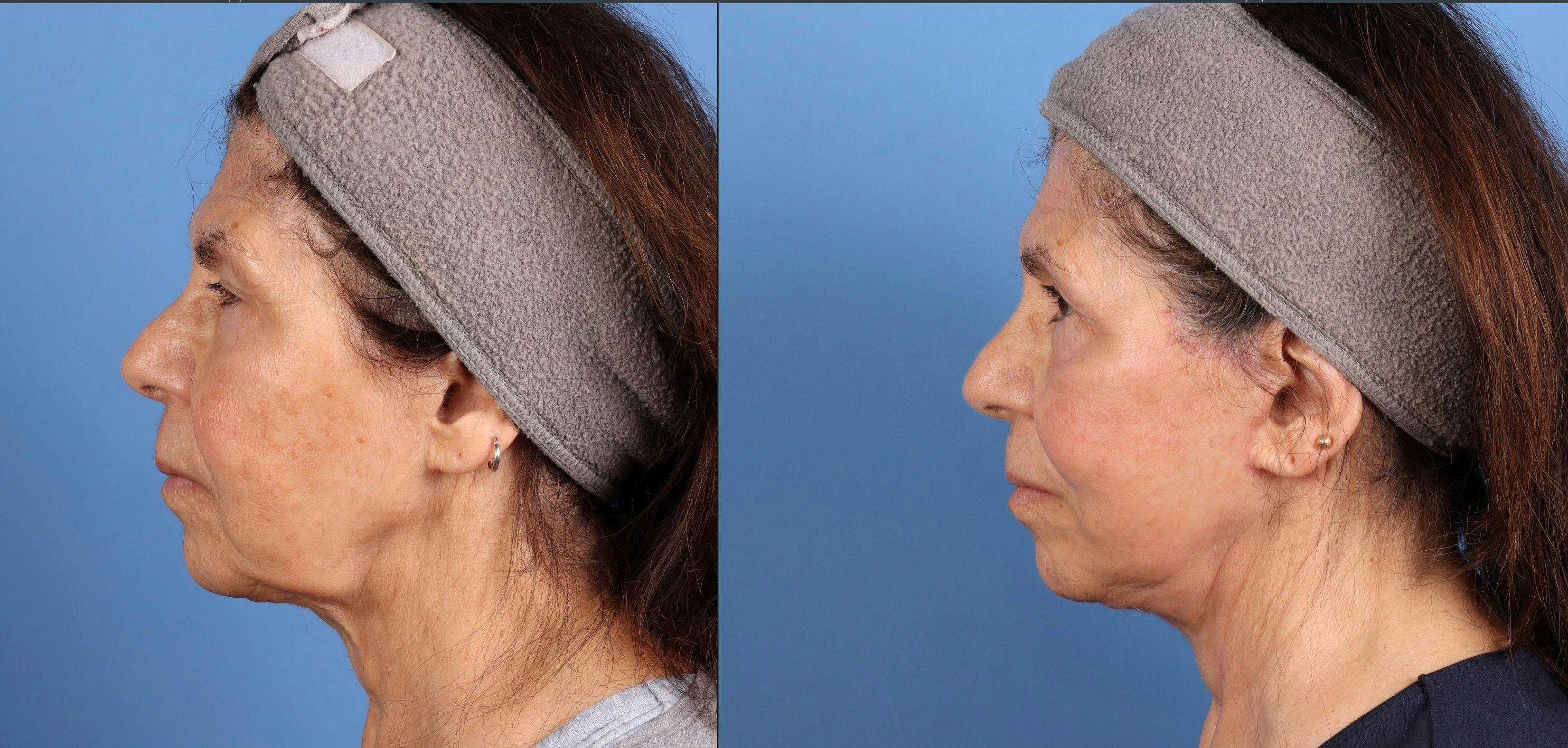 Face Lift Before & After Gallery - Patient 108966 - Image 5