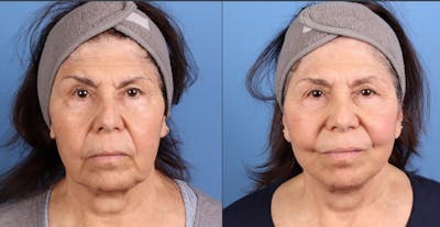 Face Lift Before & After Gallery - Patient 595252 - Image 1