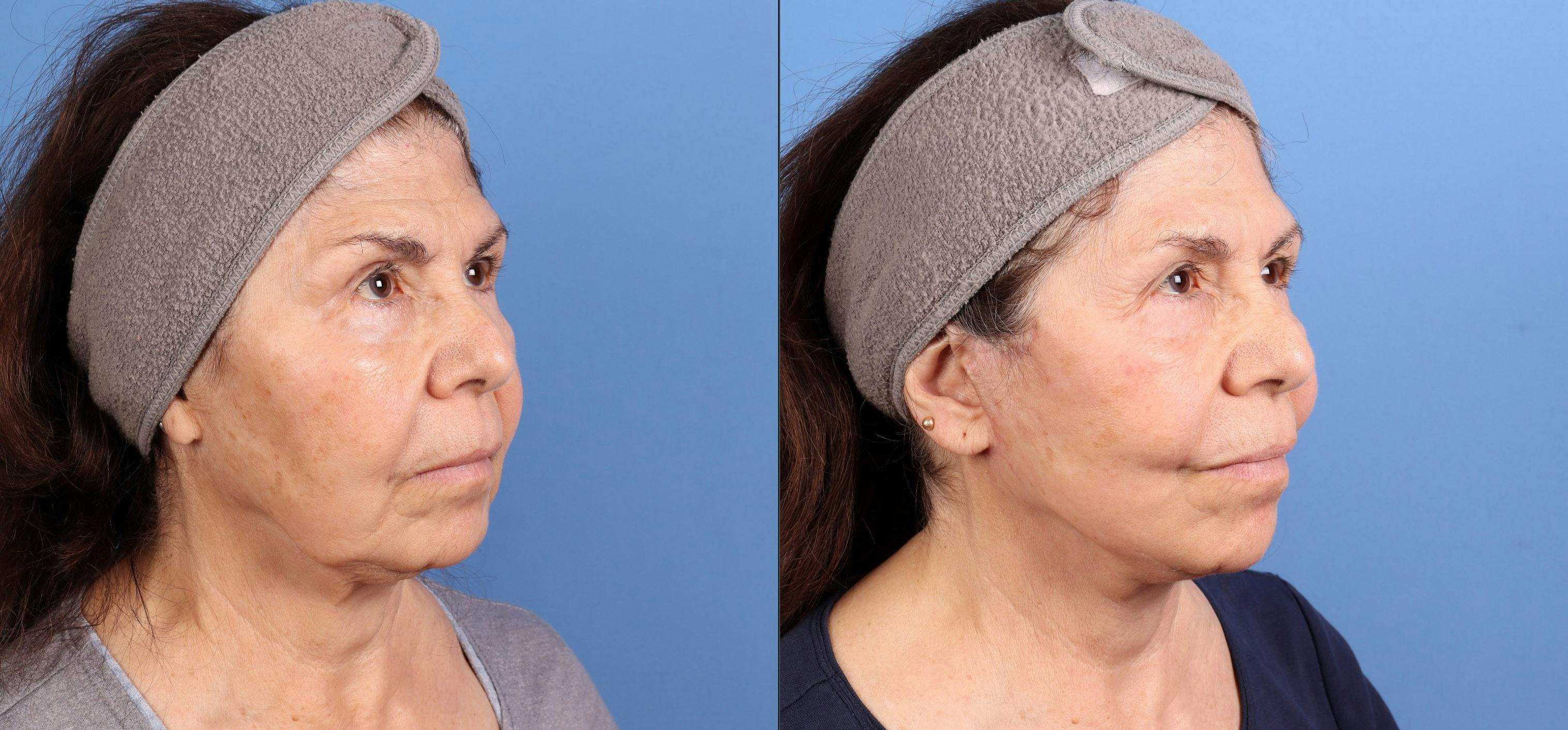 Face Lift Before & After Gallery - Patient 108966 - Image 2