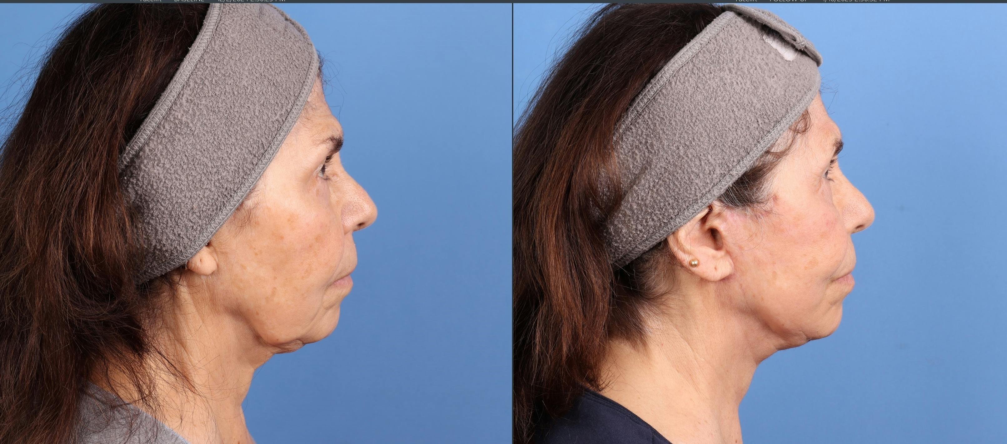 Face Lift Before & After Gallery - Patient 108966 - Image 3