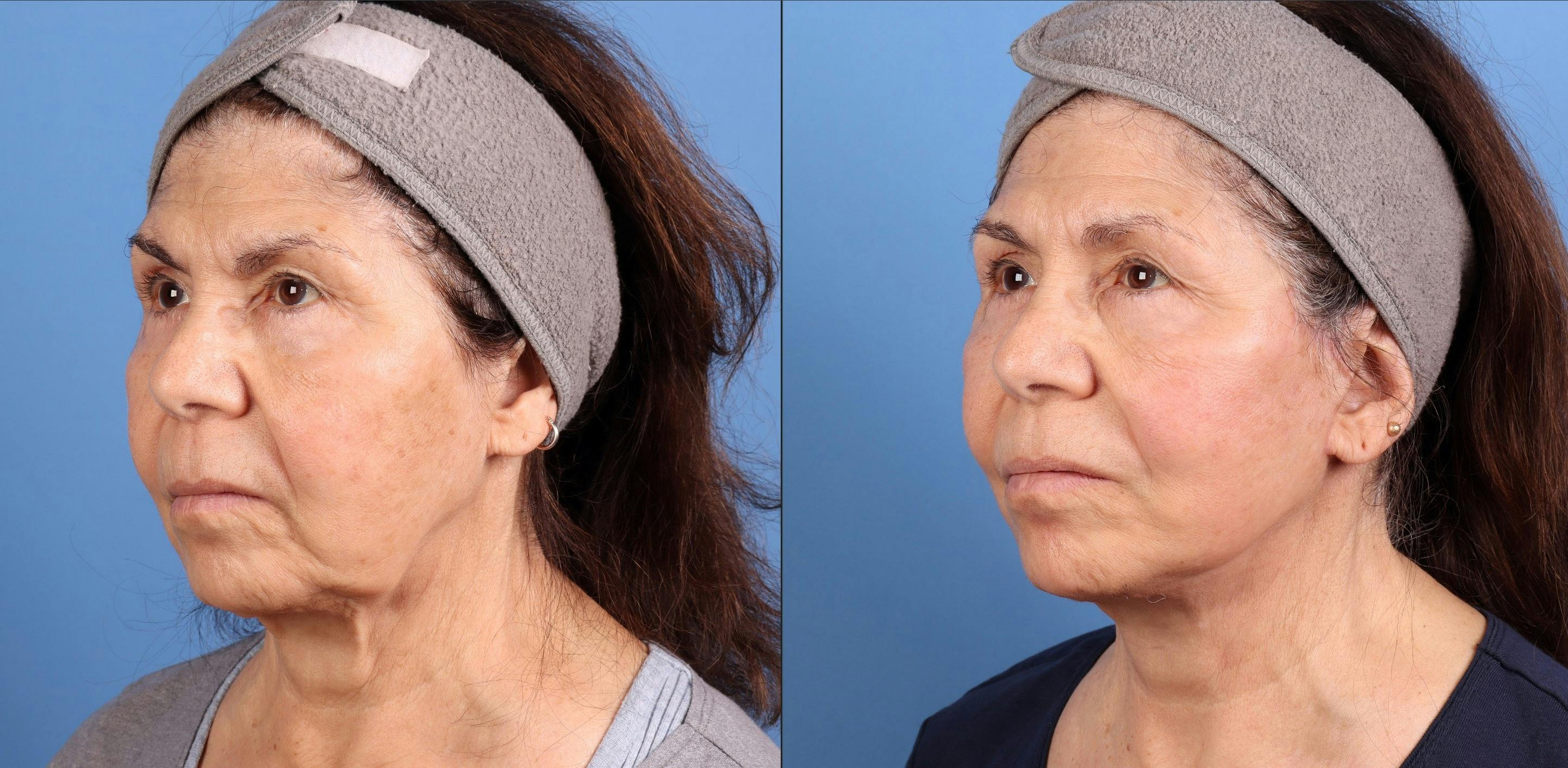 Face Lift Before & After Gallery - Patient 108966 - Image 4
