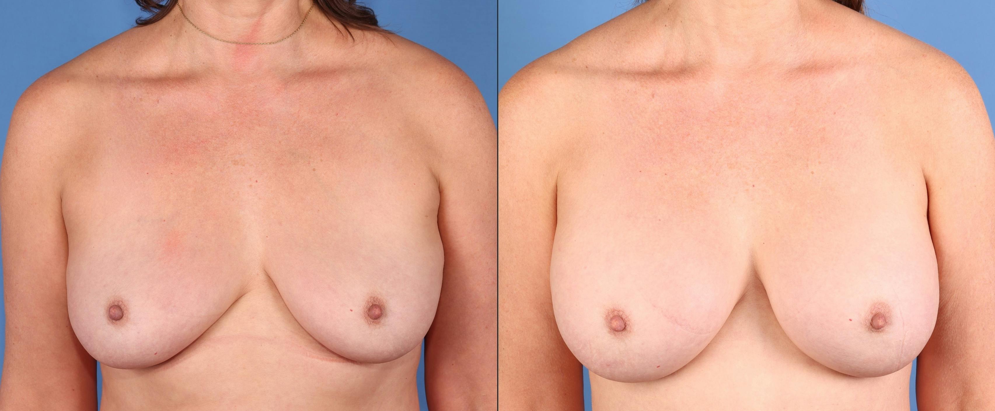 Breast Augmentation Before & After Gallery - Patient 325284 - Image 1