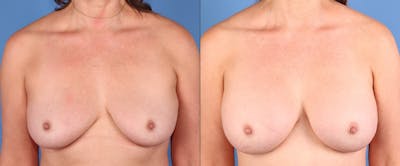 Breast Augmentation Before & After Gallery - Patient 228921 - Image 1