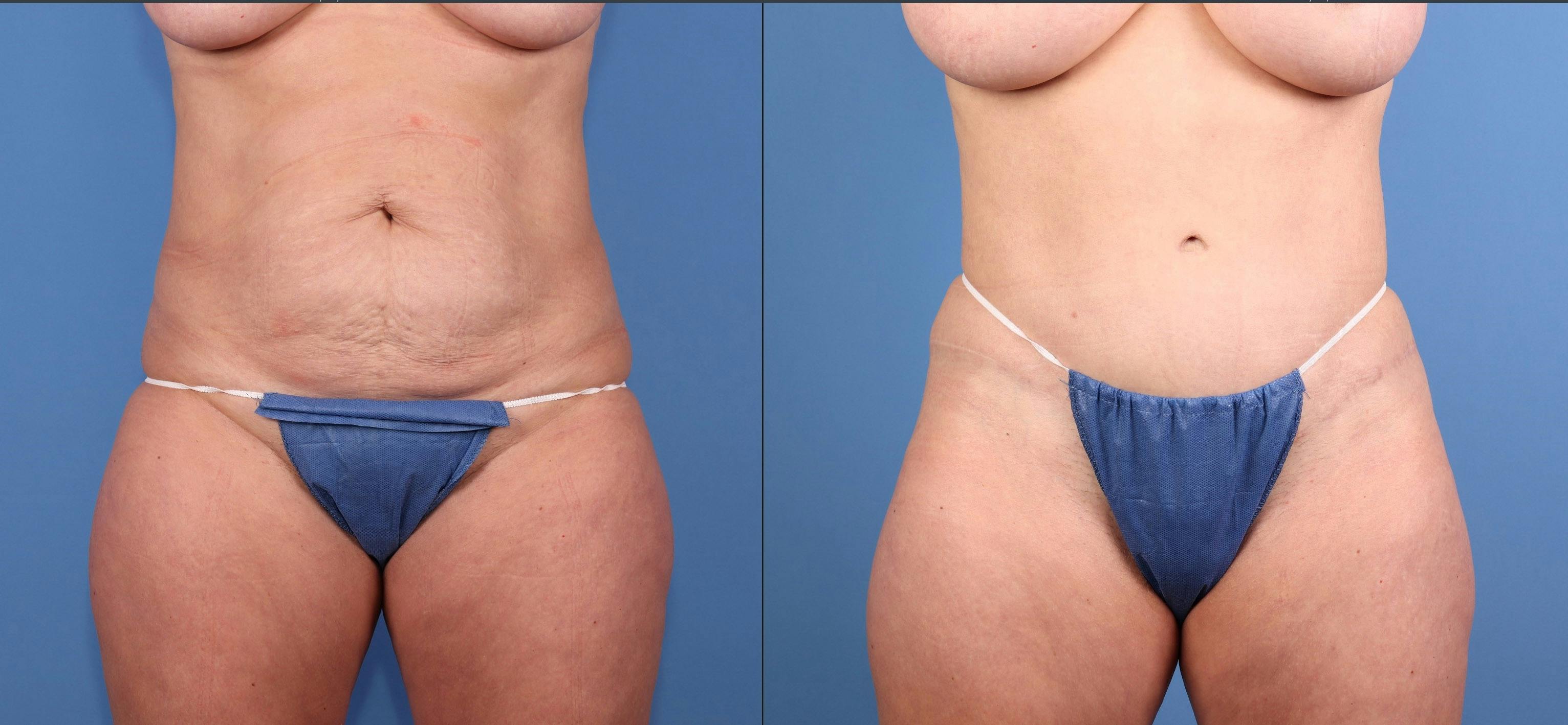 Tummy Tuck Before & After Gallery - Patient 217150 - Image 1