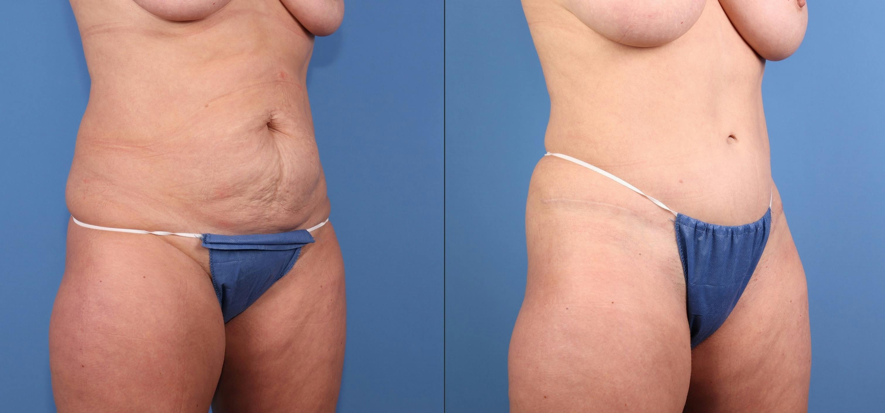 Tummy Tuck Before & After Gallery - Patient 217150 - Image 2