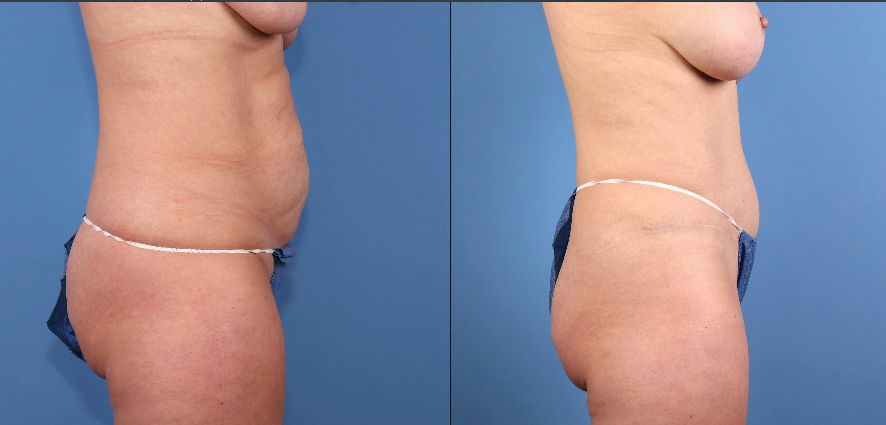 Tummy Tuck Before & After Gallery - Patient 217150 - Image 3