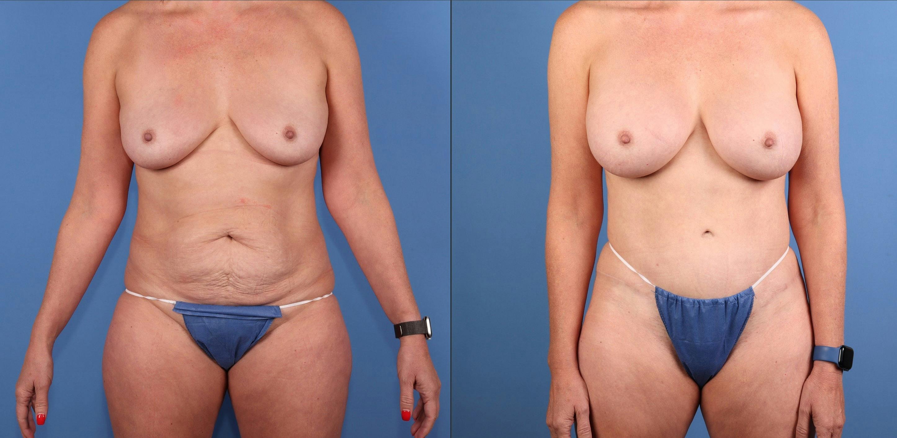 Mommy Makeover Before & After Gallery - Patient 103309 - Image 1