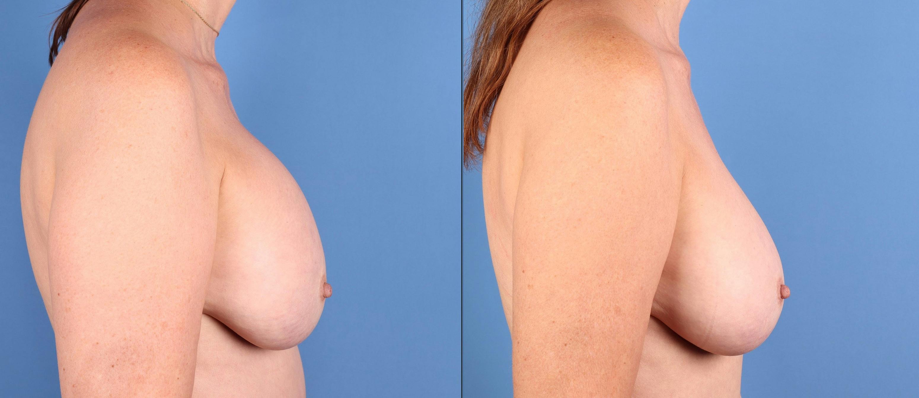 Aspen After Surgery Before & After Gallery - Patient 144405739 - Image 3