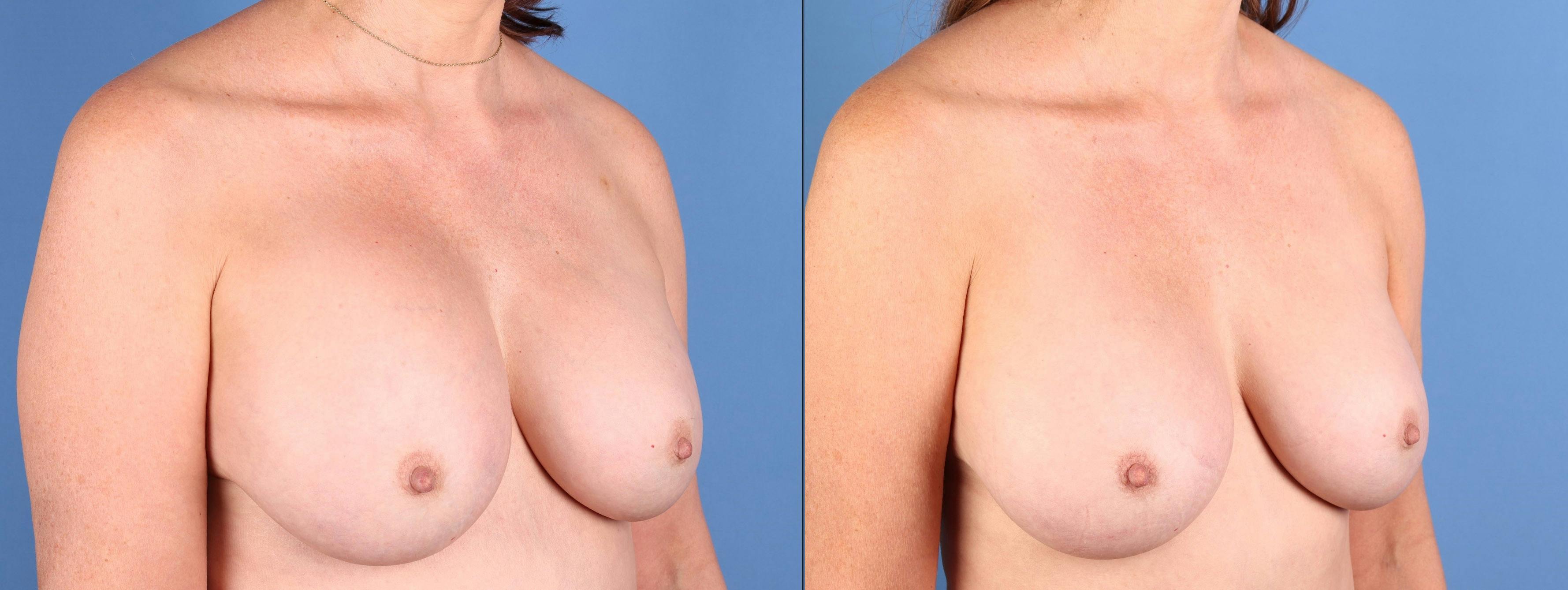 Aspen After Surgery Before & After Gallery - Patient 144405739 - Image 2