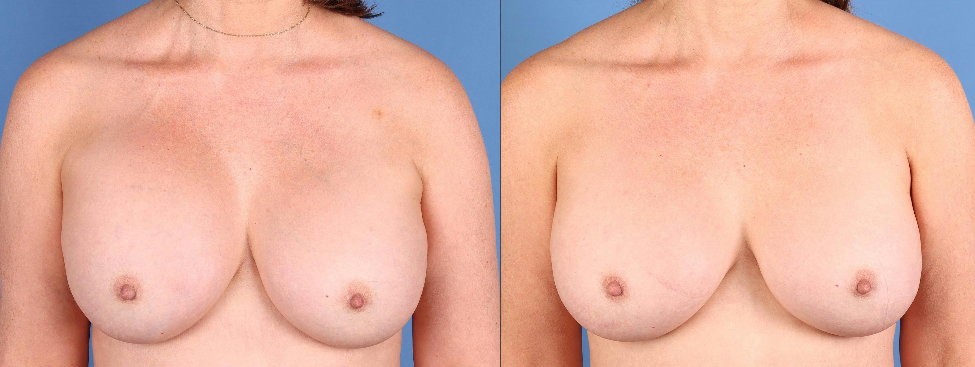 Aspen After Surgery Before & After Gallery - Patient 144405739 - Image 1