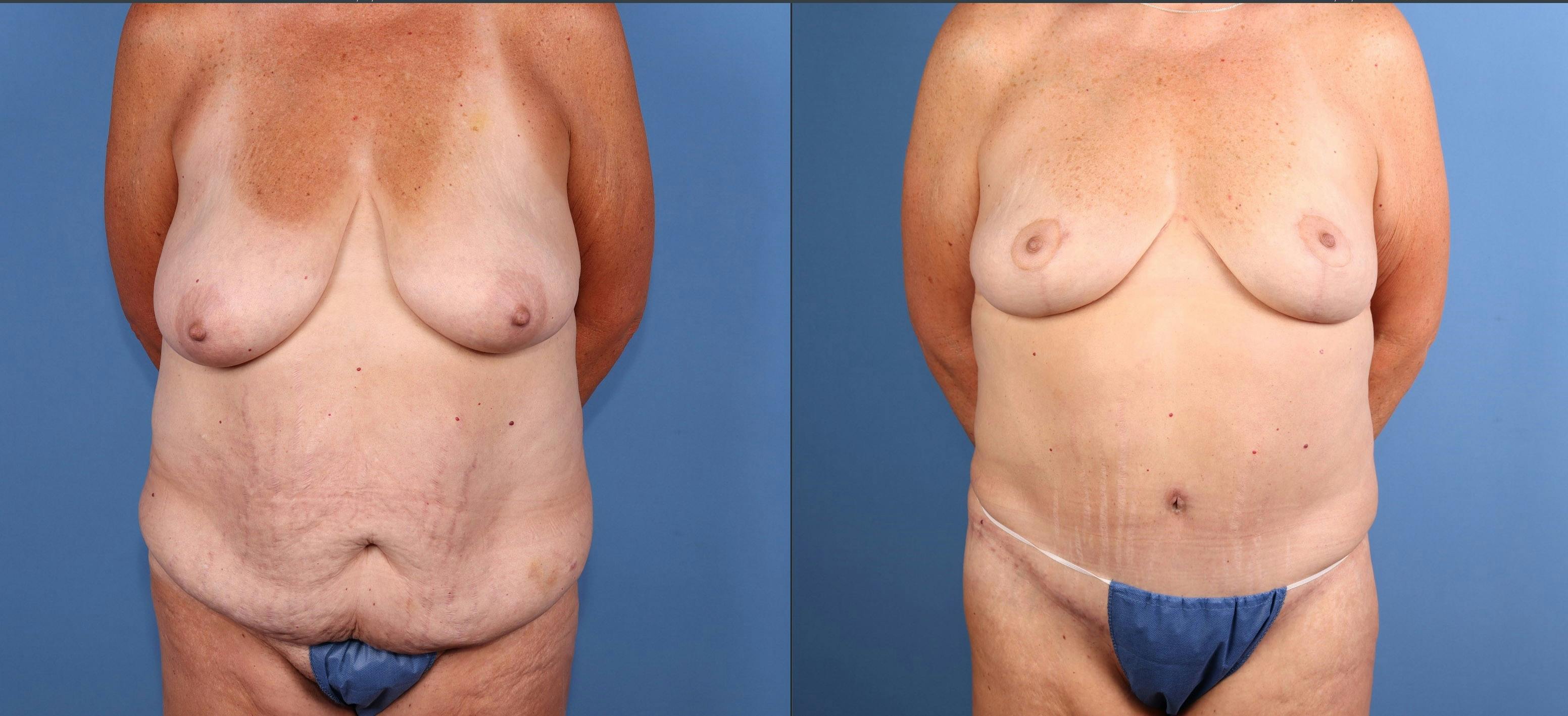 Tummy Tuck Before & After Gallery - Patient 417282 - Image 1