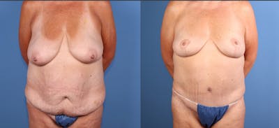 Tummy Tuck Before & After Gallery - Patient 371921 - Image 1