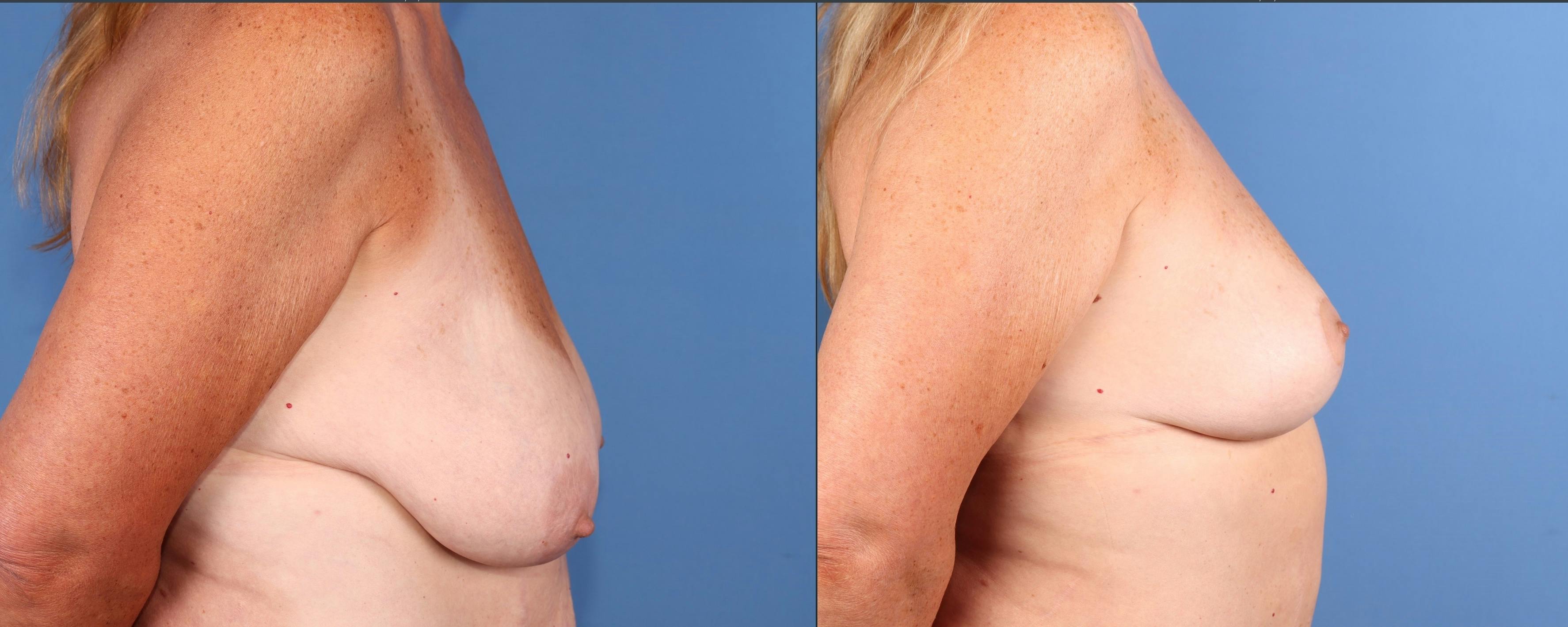 Breast Lift Before & After Gallery - Patient 156632 - Image 3