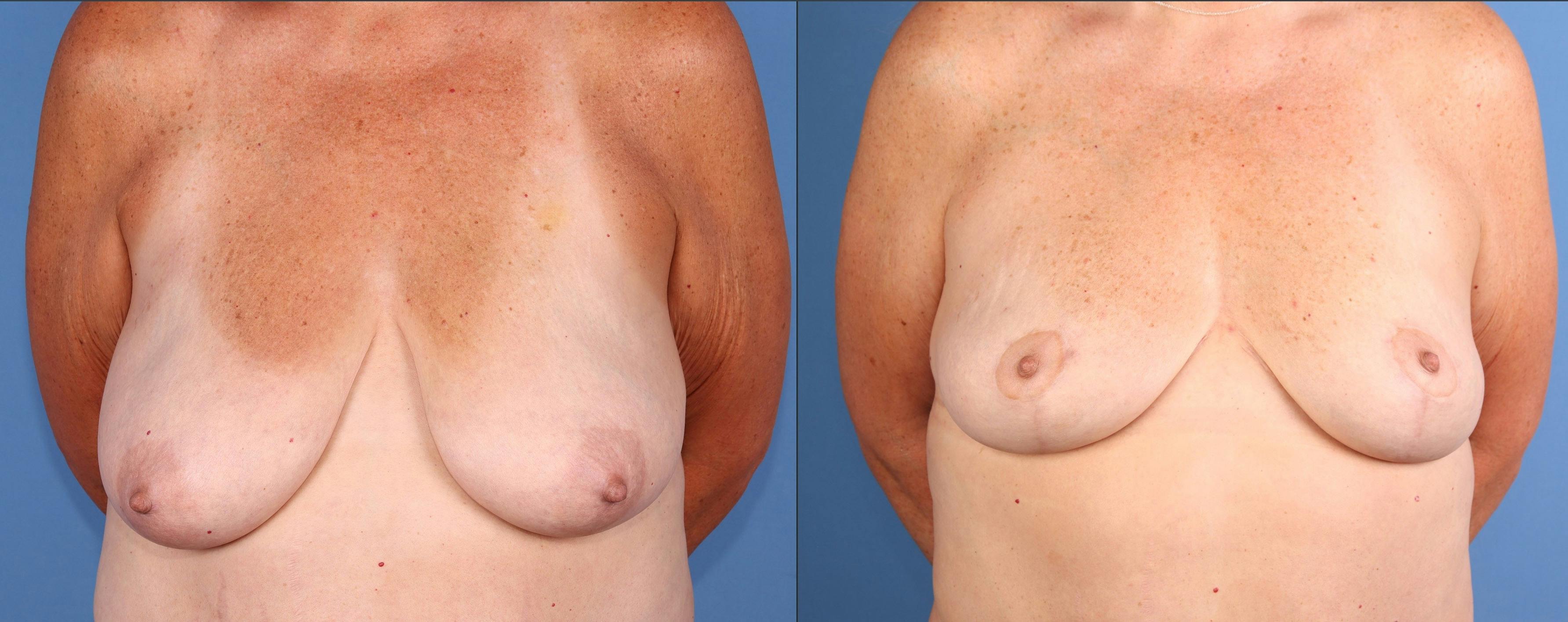 Breast Lift Before & After Gallery - Patient 156632 - Image 1