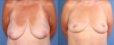 Breast Lift Before & After Gallery - Patient 156632 - Image 1