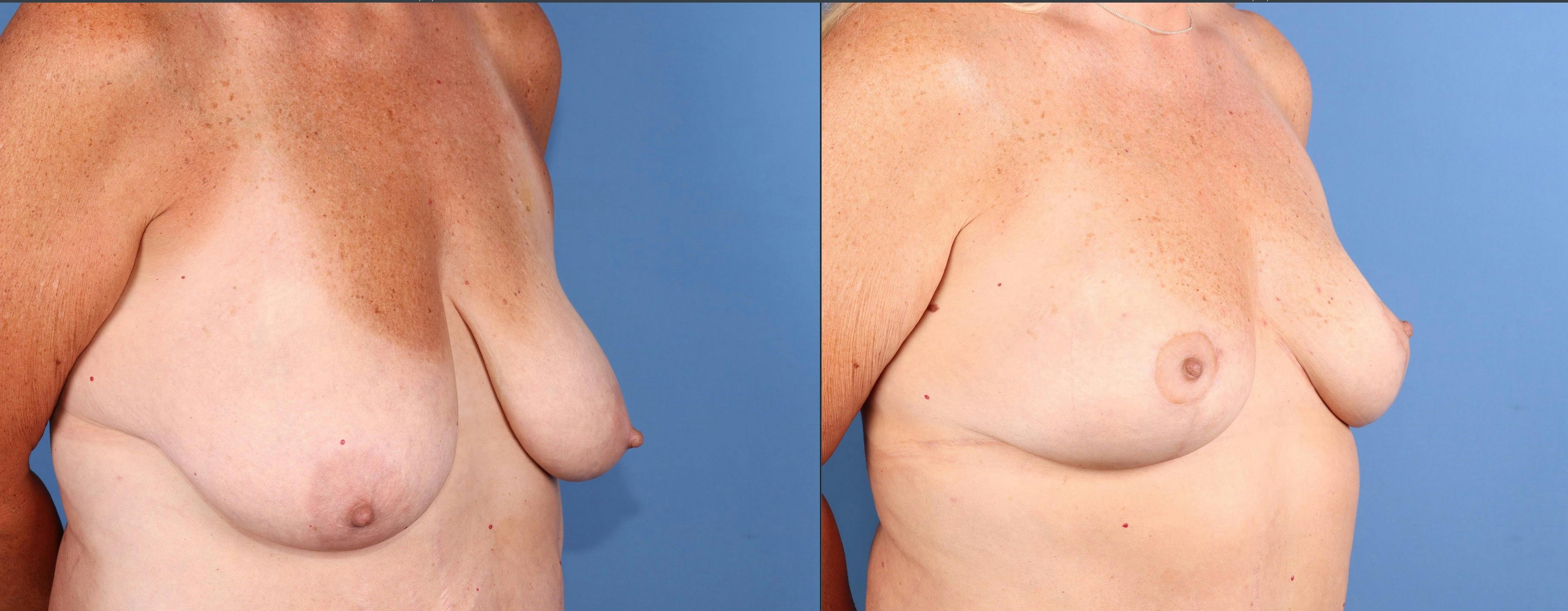 Breast Lift Before & After Gallery - Patient 156632 - Image 2