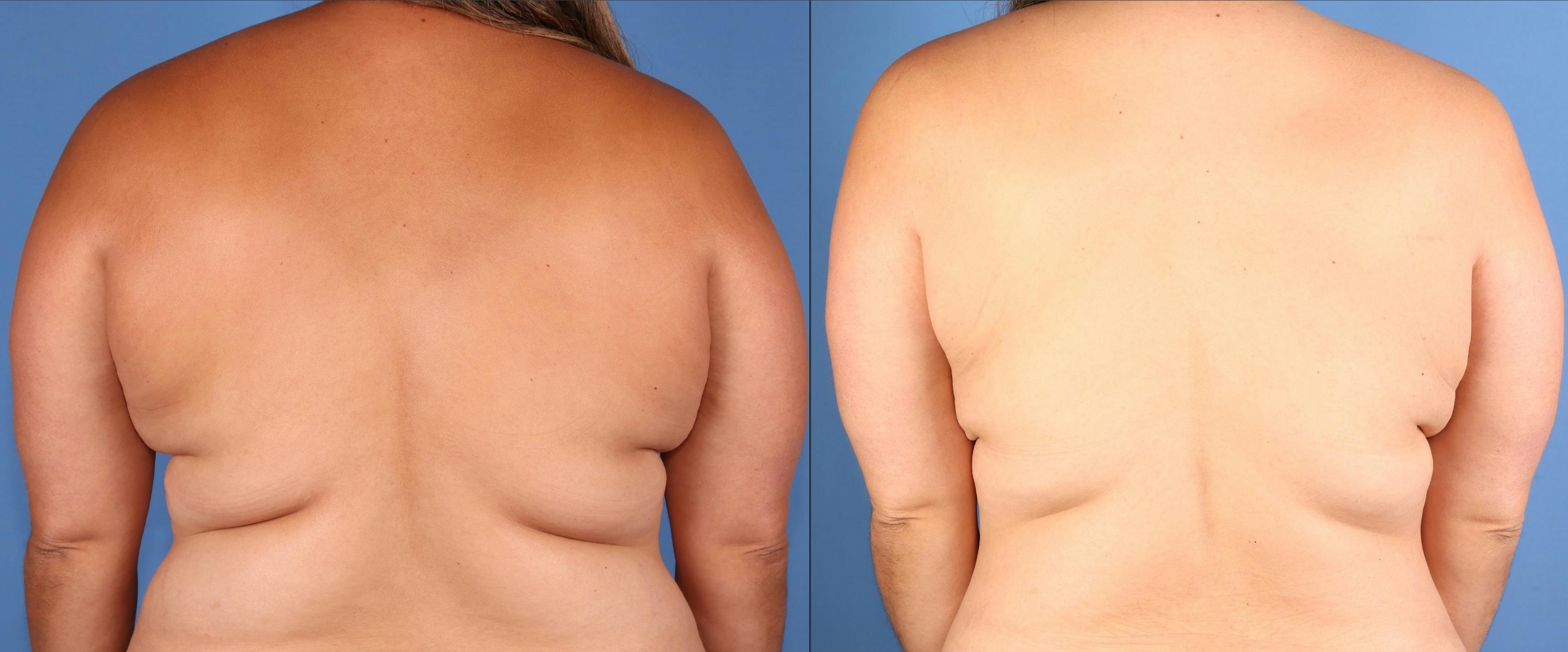 Back Before & After Gallery - Patient 302363 - Image 1