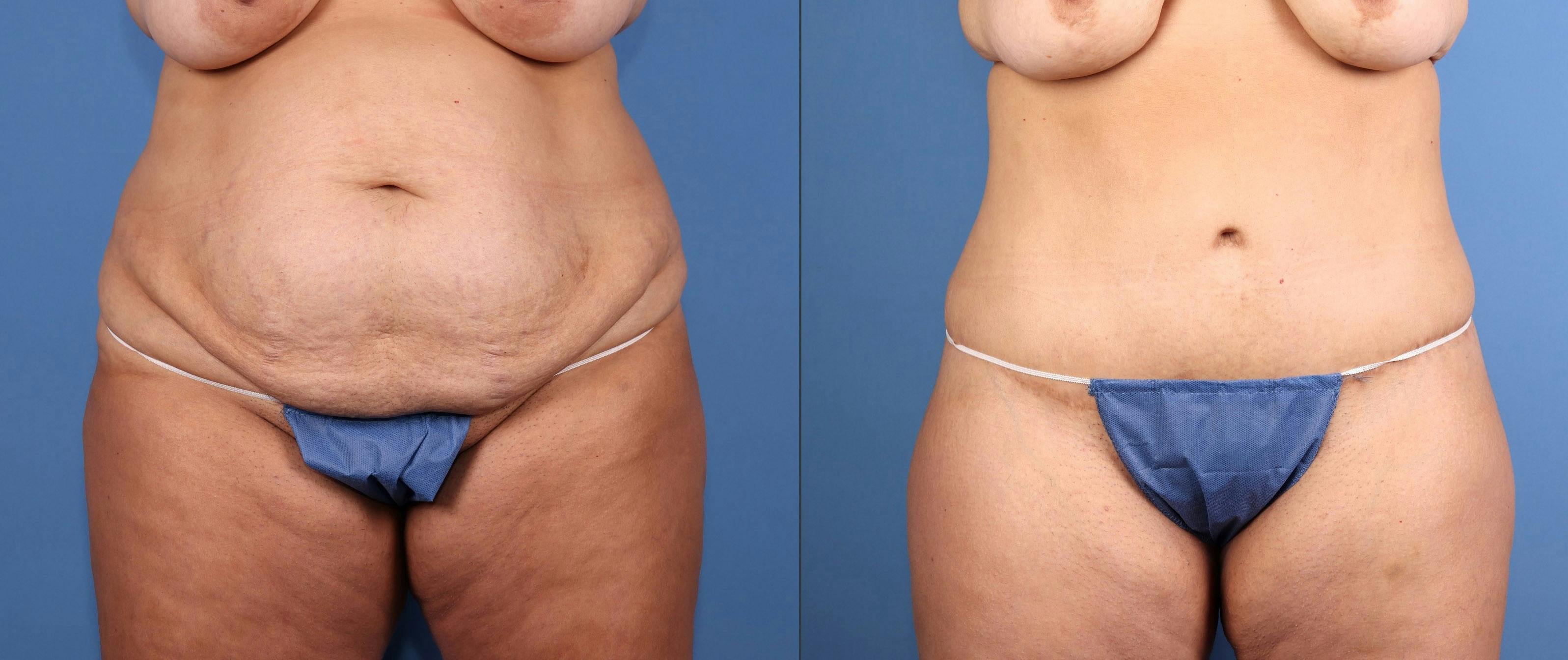 Tummy Tuck Before & After Gallery - Patient 179885 - Image 1