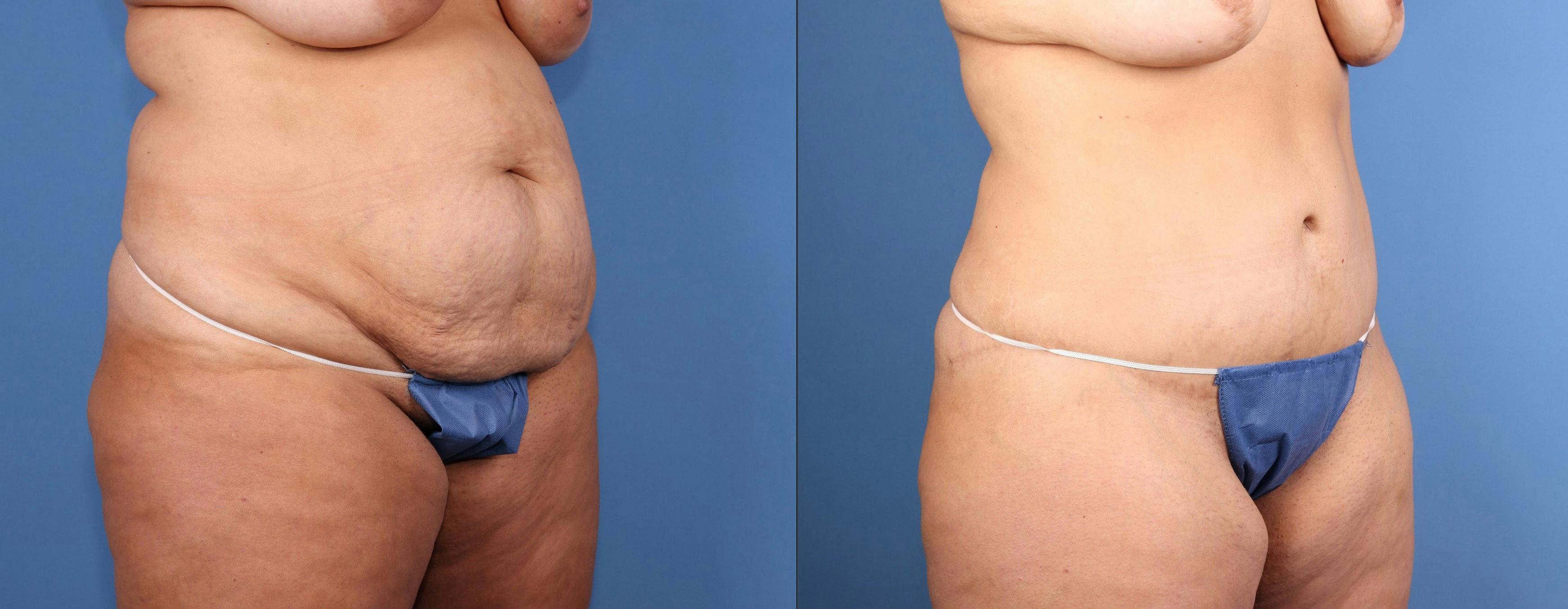 Tummy Tuck Before & After Gallery - Patient 179885 - Image 2