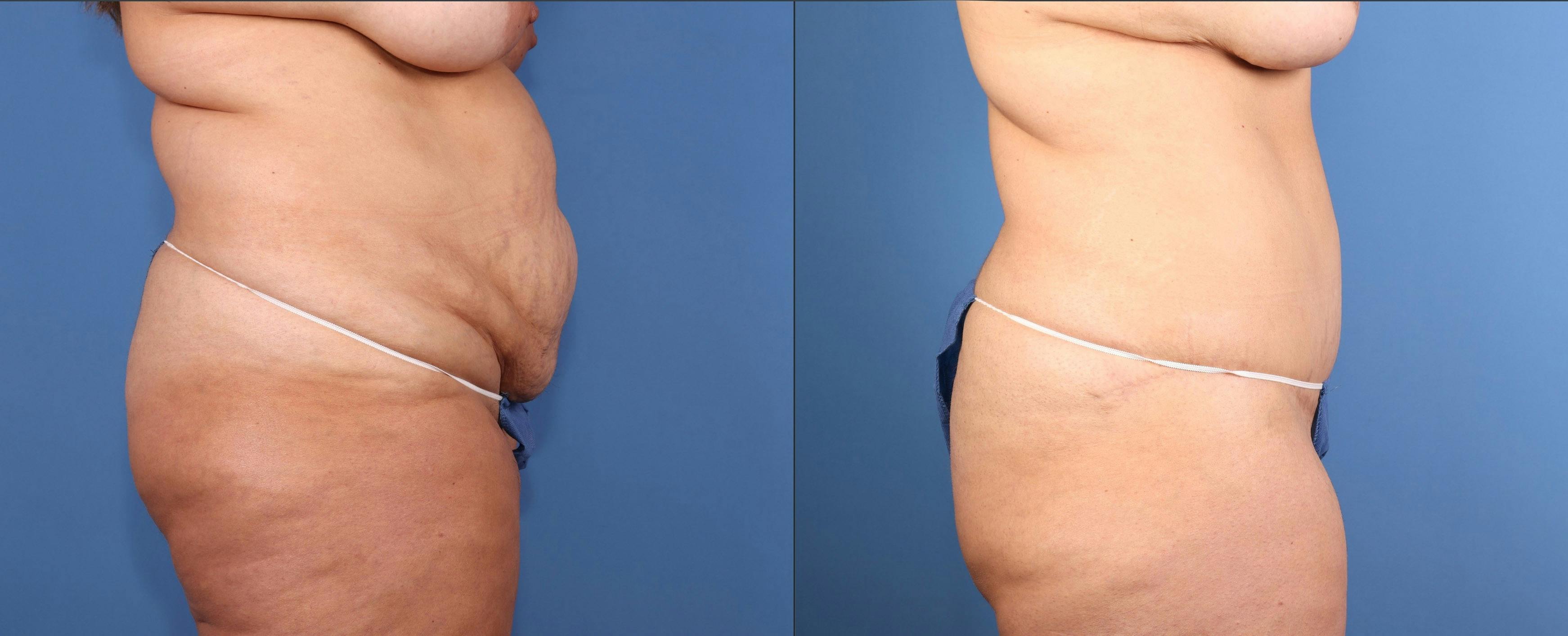 Tummy Tuck Before & After Gallery - Patient 179885 - Image 3