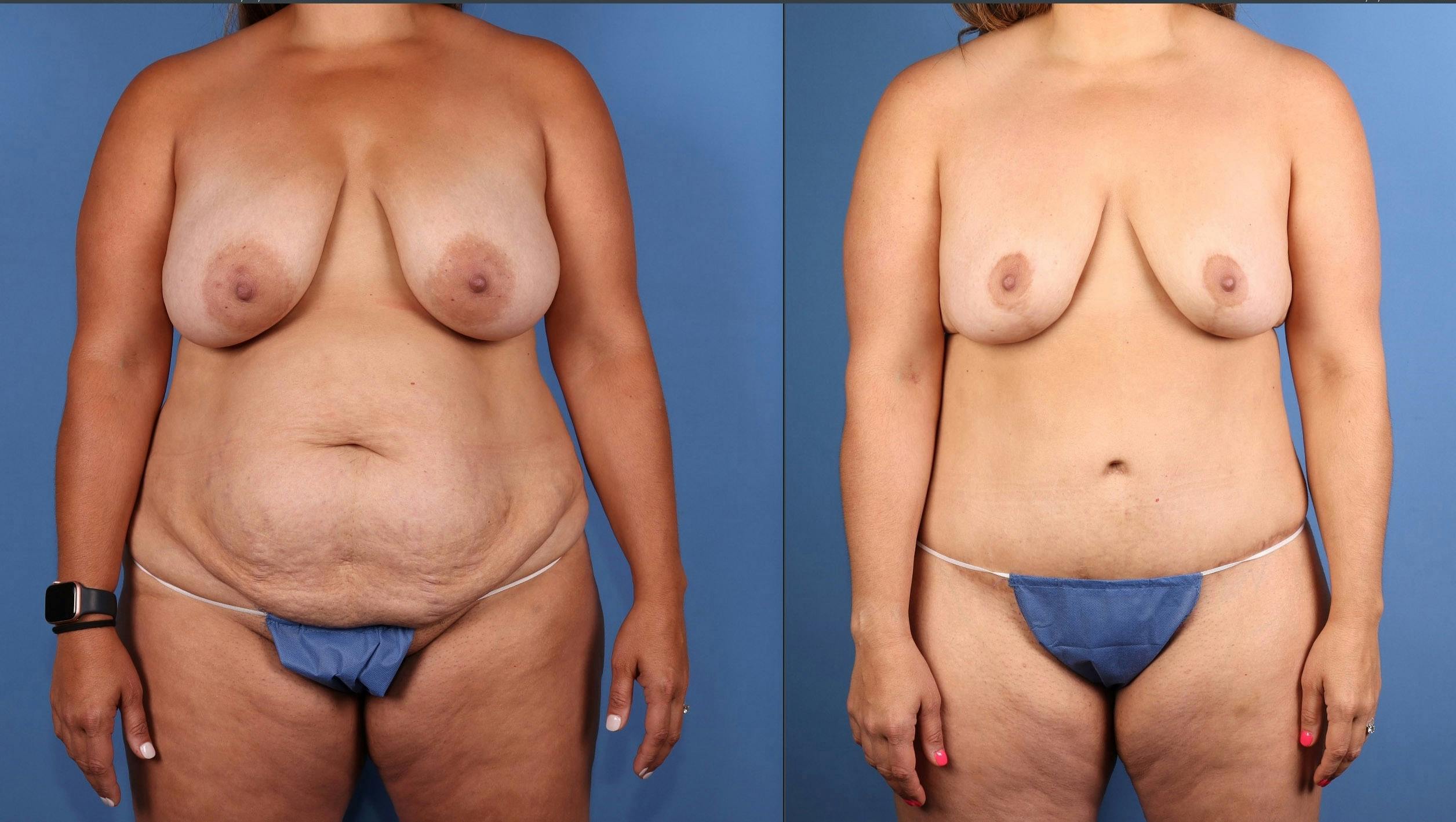 Tummy Tuck Before & After Gallery - Patient 179885 - Image 4