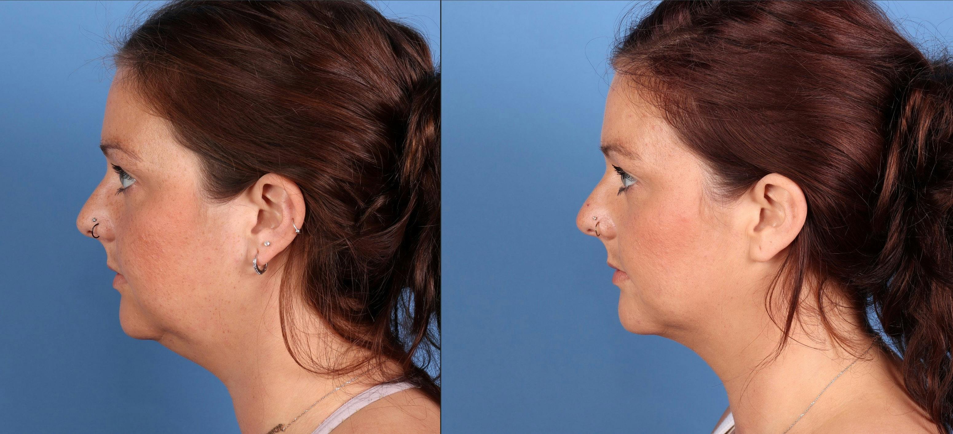 Face & Neck Before & After Gallery - Patient 338595 - Image 2