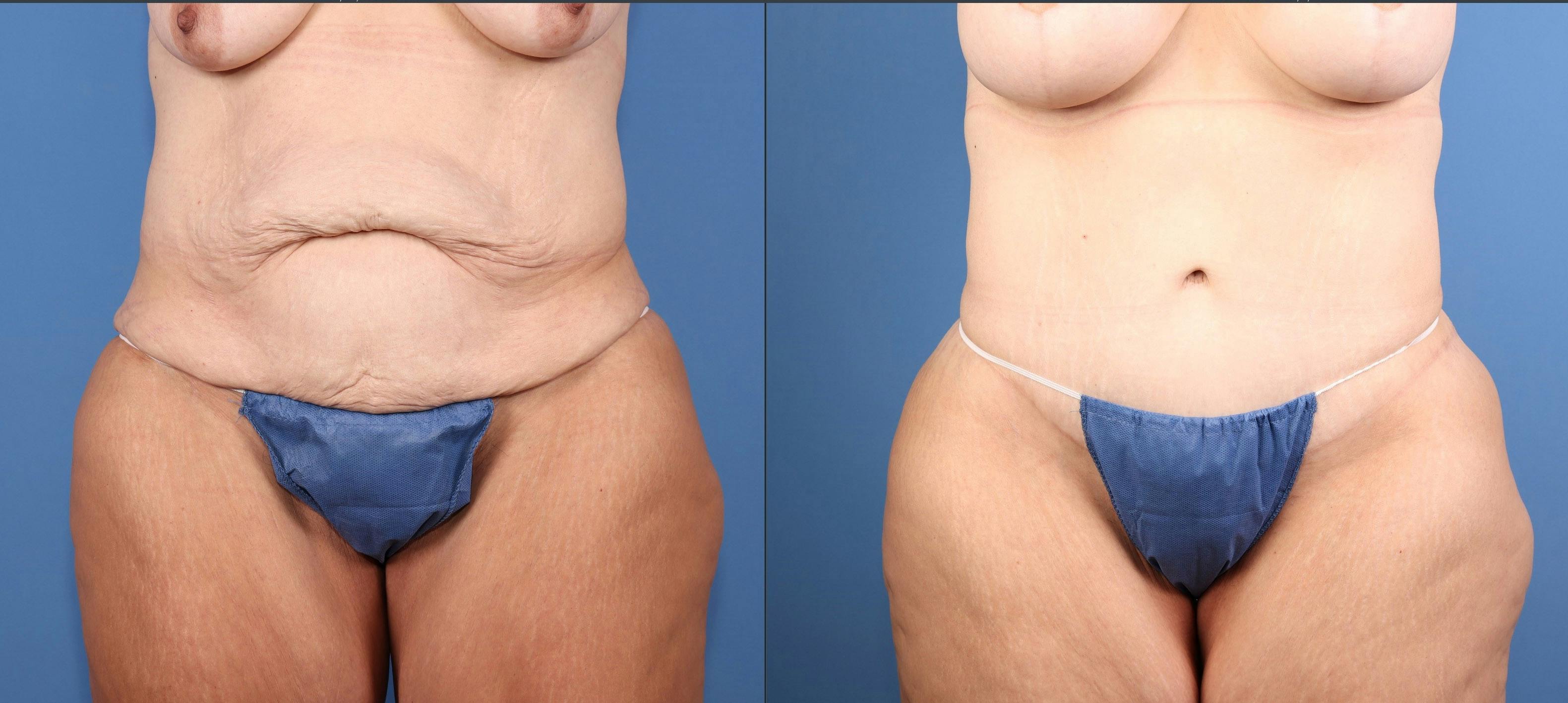 Tummy Tuck Before & After Gallery - Patient 846088 - Image 1