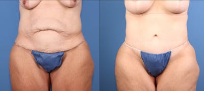 Tummy Tuck Before & After Gallery - Patient 846088 - Image 1