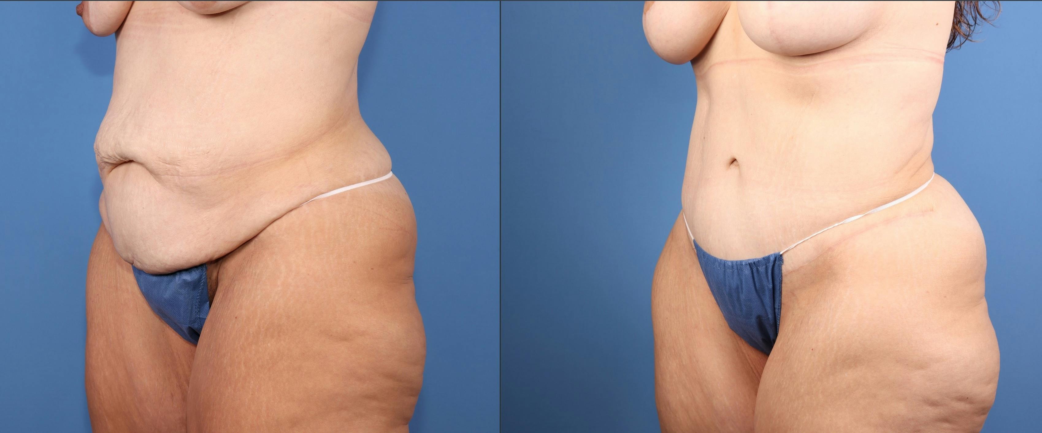 Tummy Tuck Before & After Gallery - Patient 846088 - Image 2