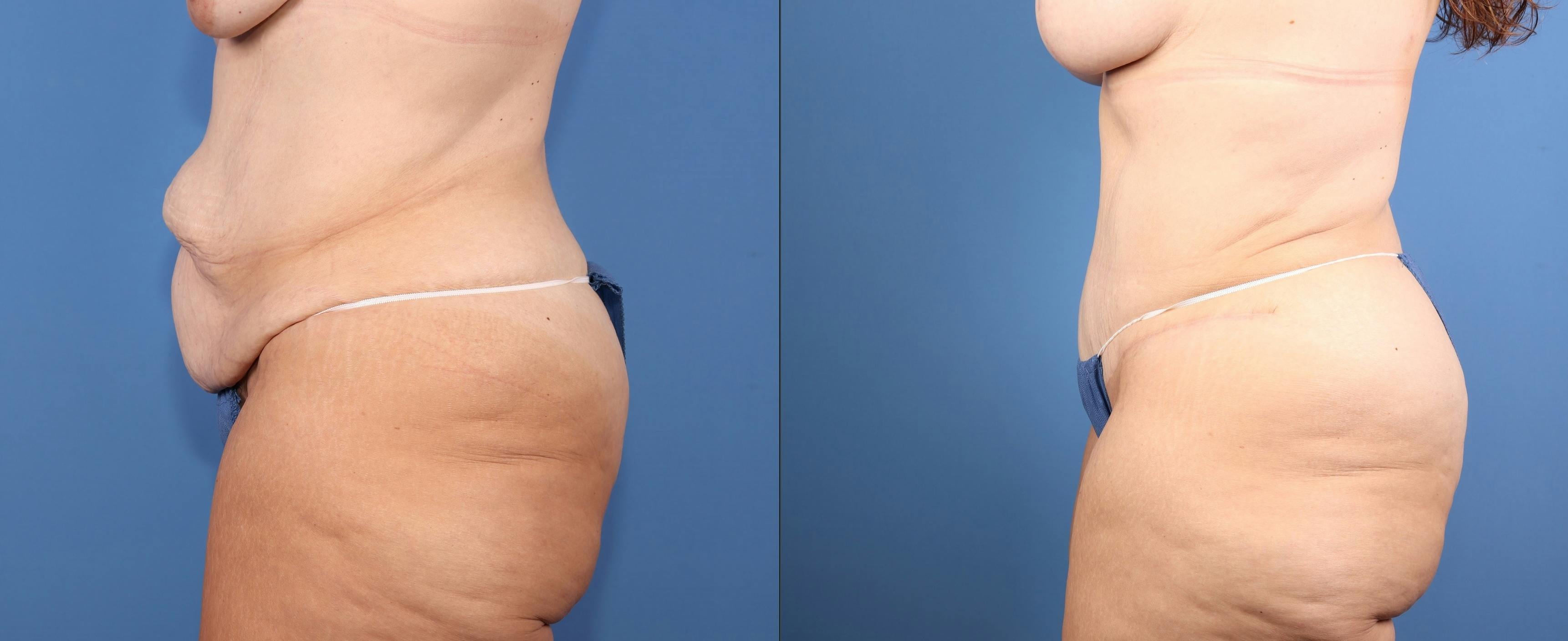 Tummy Tuck Before & After Gallery - Patient 846088 - Image 3