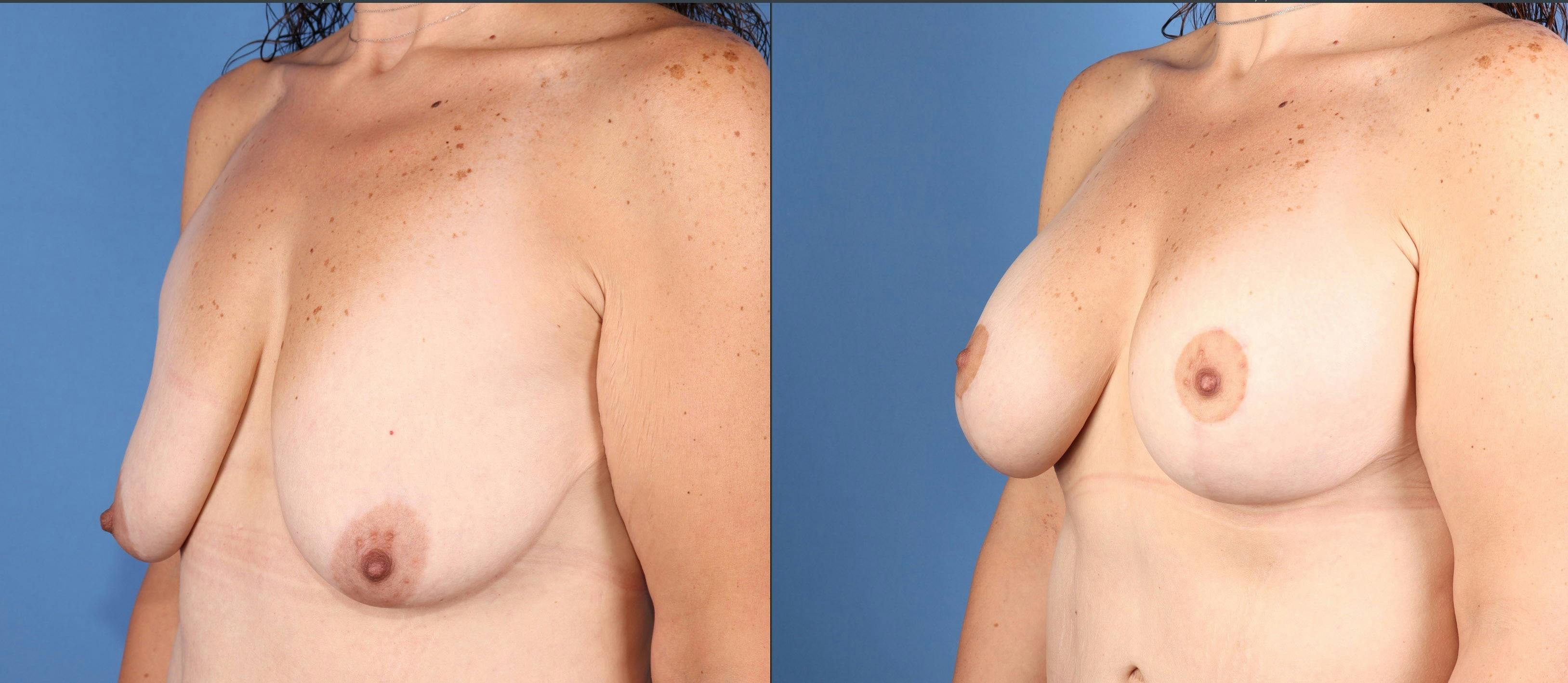 Breast Lift with Augmentation Before & After Gallery - Patient 261244 - Image 2