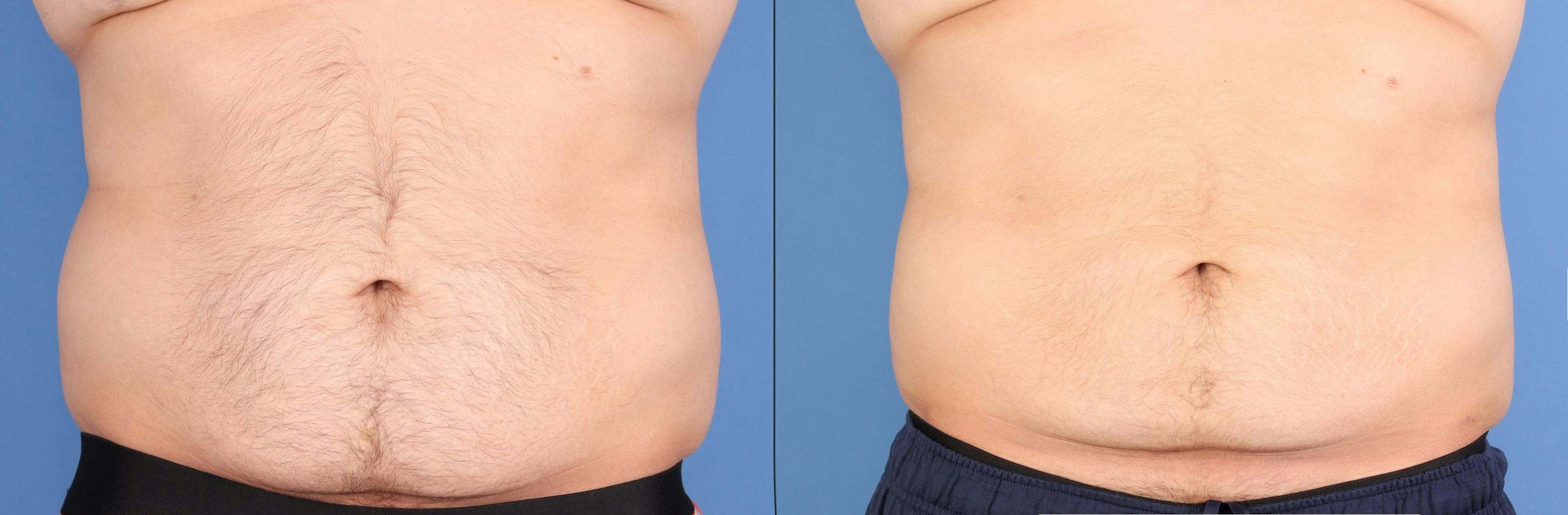 Abdomen Before & After Gallery - Patient 268635 - Image 1