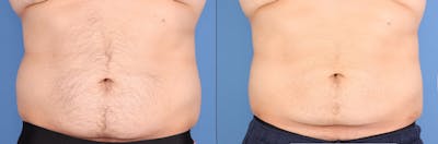 Abdomen Before & After Gallery - Patient 268635 - Image 1