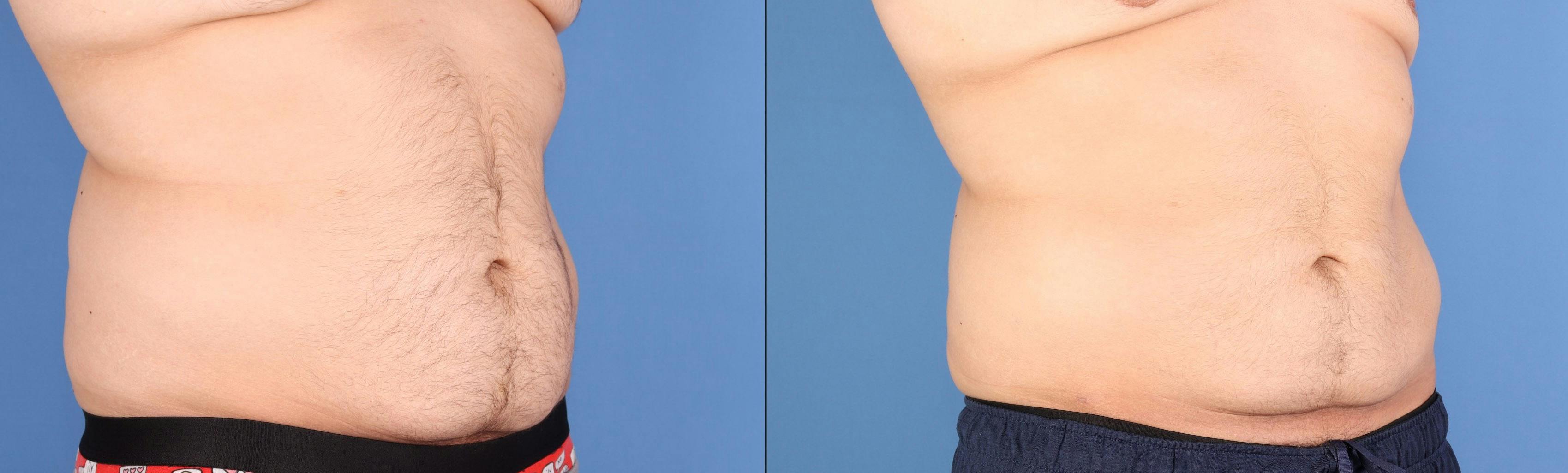 Abdomen Before & After Gallery - Patient 268635 - Image 2