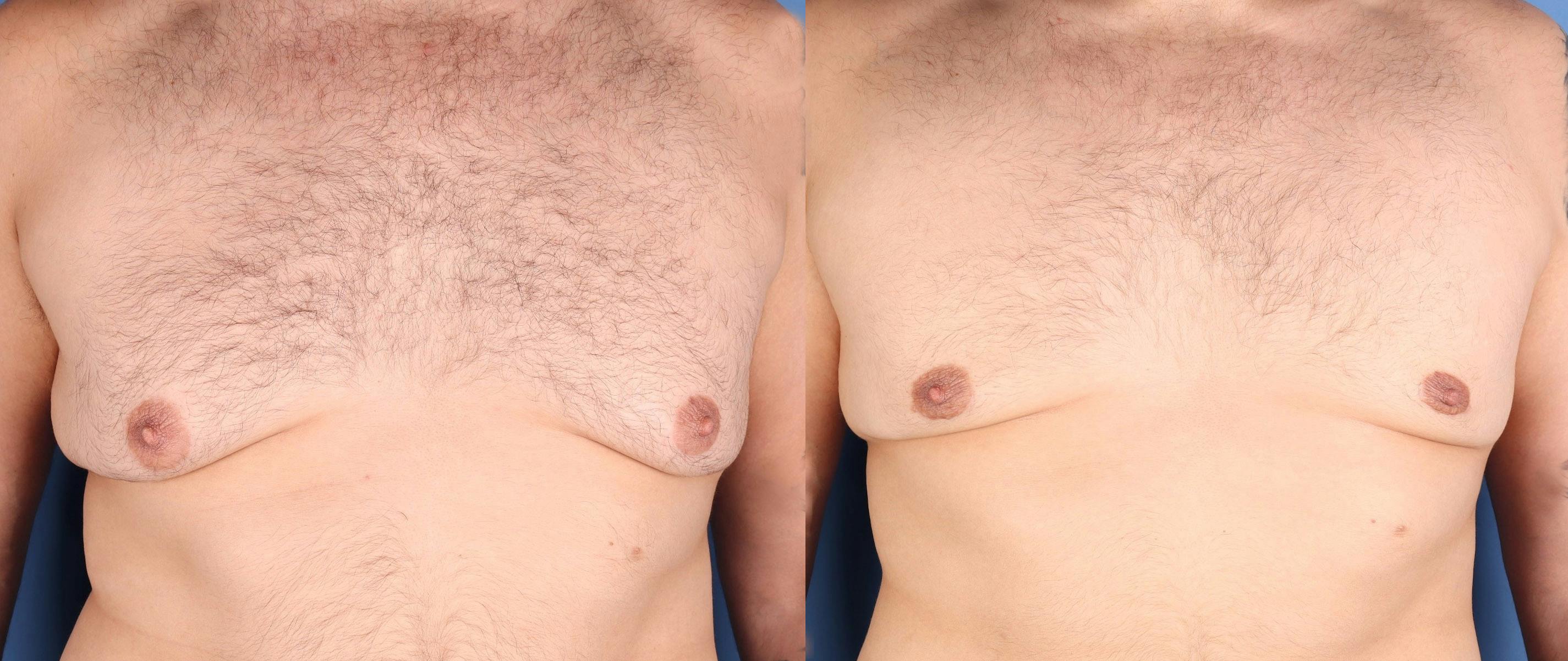 Male Breast Reduction Before & After Gallery - Patient 184121 - Image 1
