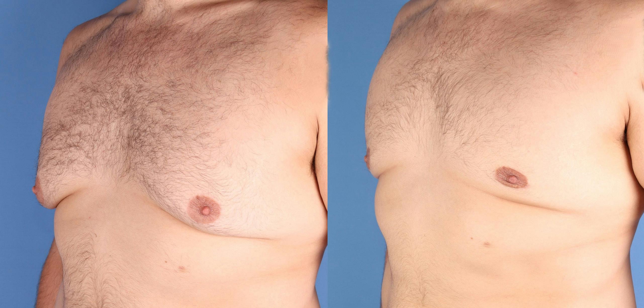Male Breast Reduction Before & After Gallery - Patient 184121 - Image 2
