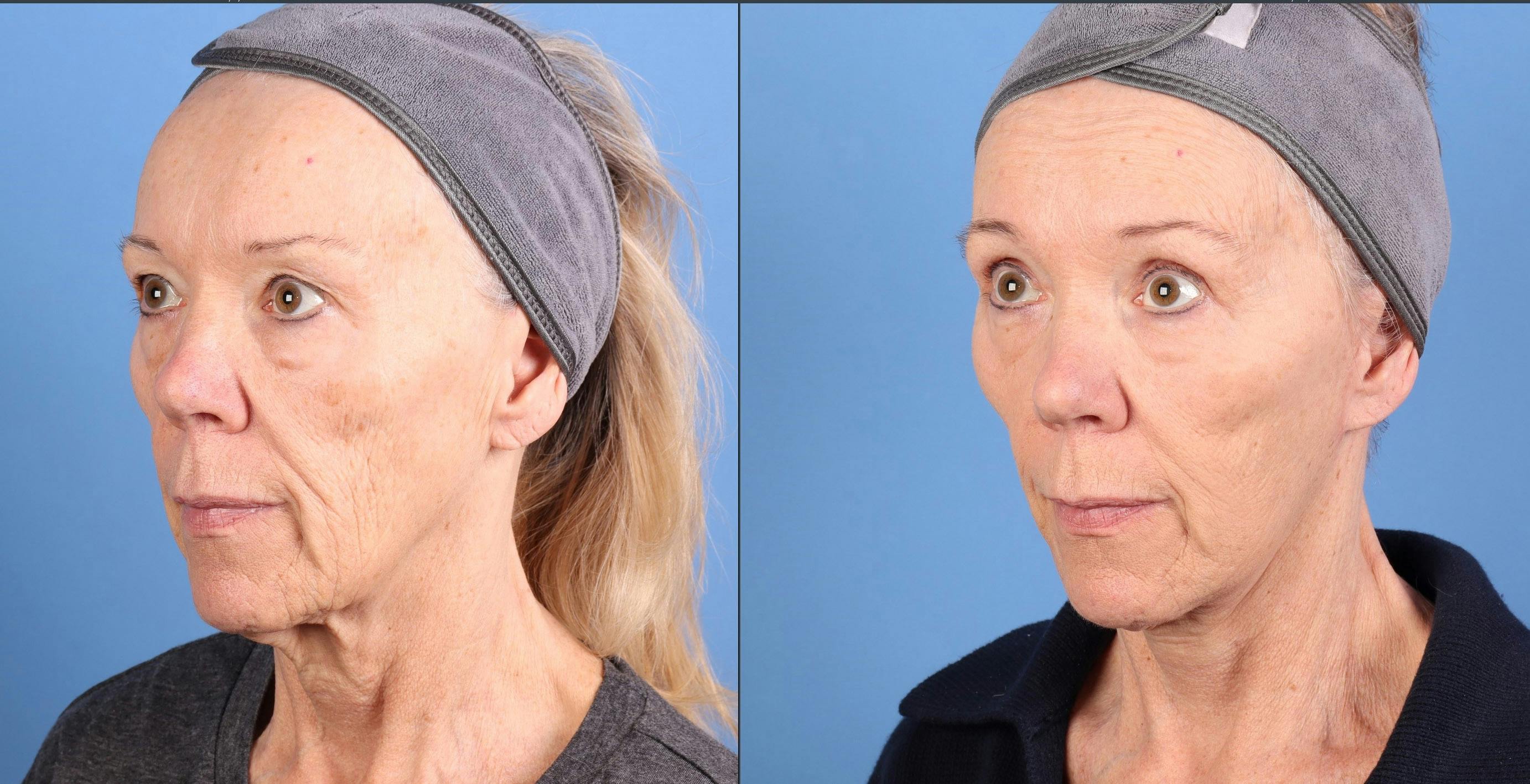 Eyelid Surgery (Upper Blepharoplasty) Before & After Gallery - Patient 123848 - Image 2