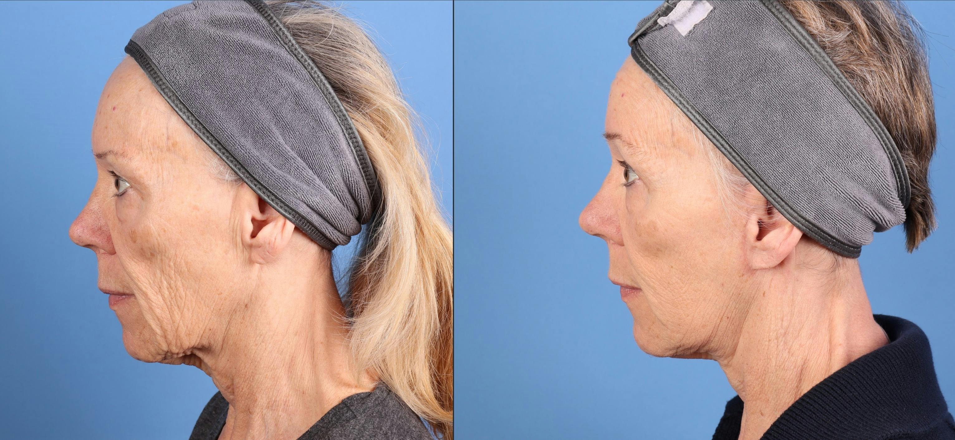 Eyelid Surgery (Upper Blepharoplasty) Before & After Gallery - Patient 123848 - Image 3