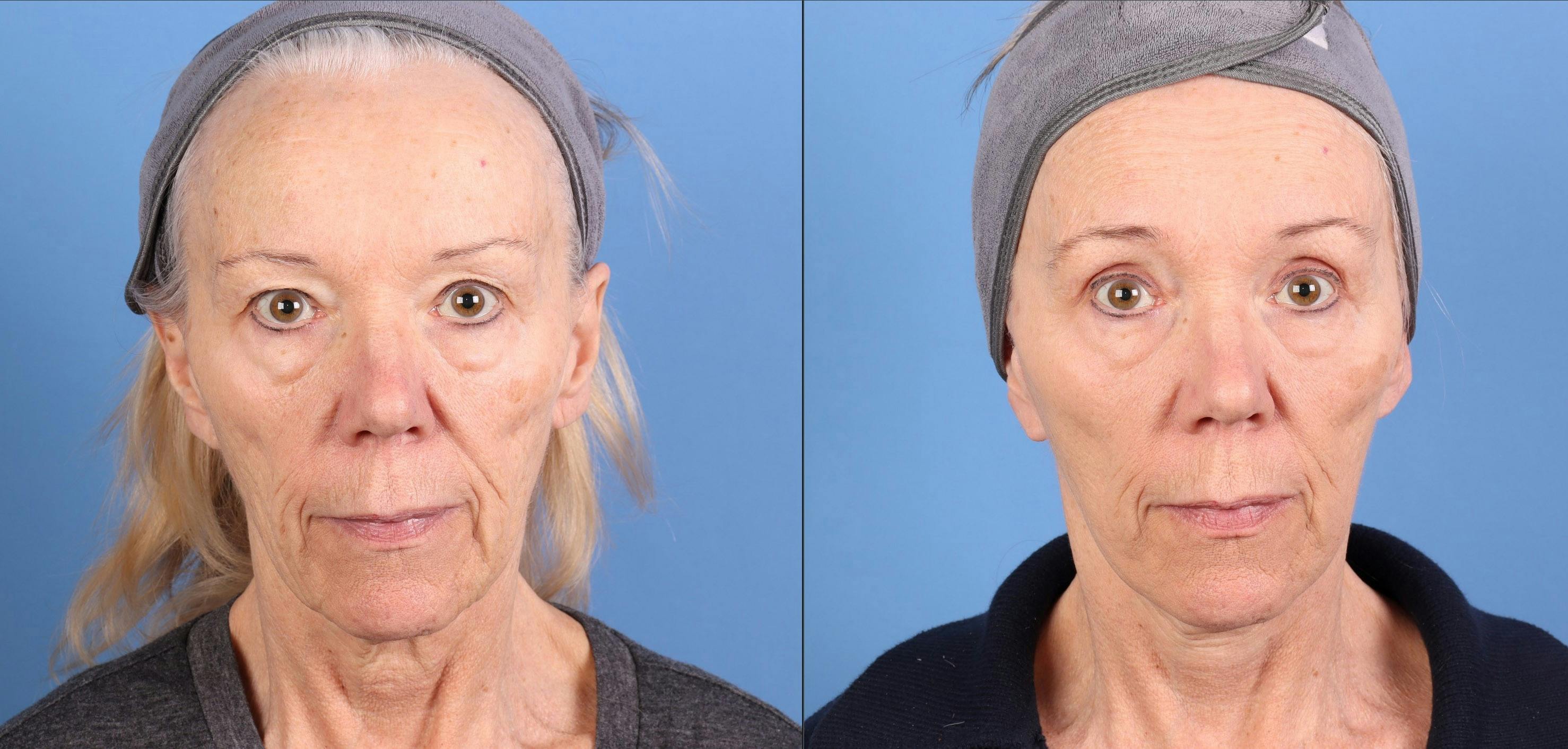 Face Lift Before & After Gallery - Patient 108966 - Image 1
