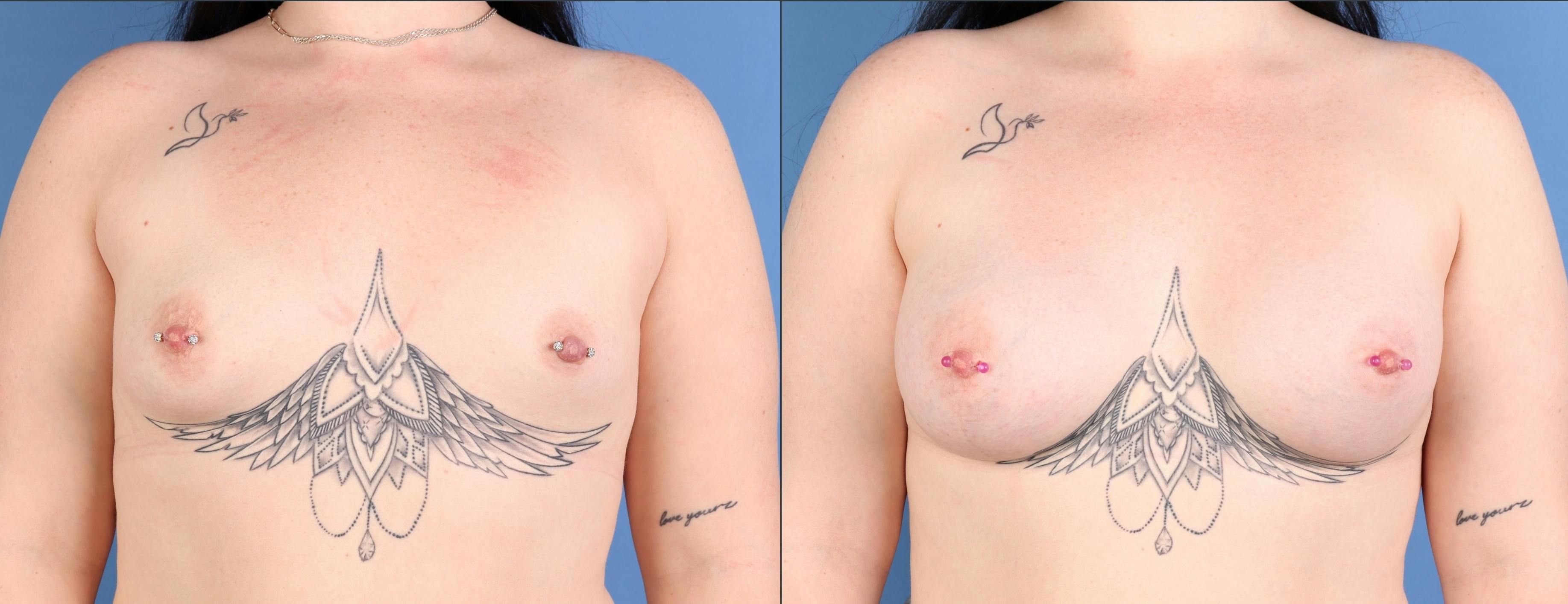 Breast Augmentation Before & After Gallery - Patient 325284 - Image 1