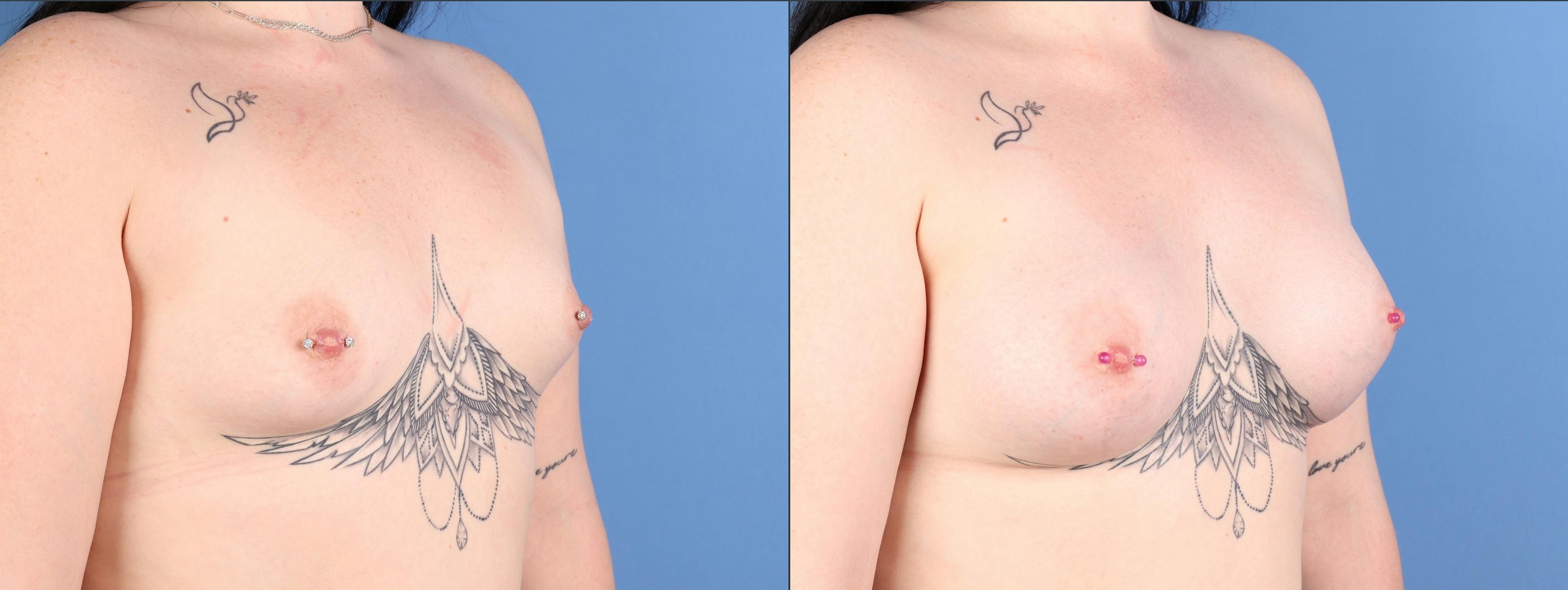 Breast Augmentation Before & After Gallery - Patient 325284 - Image 2