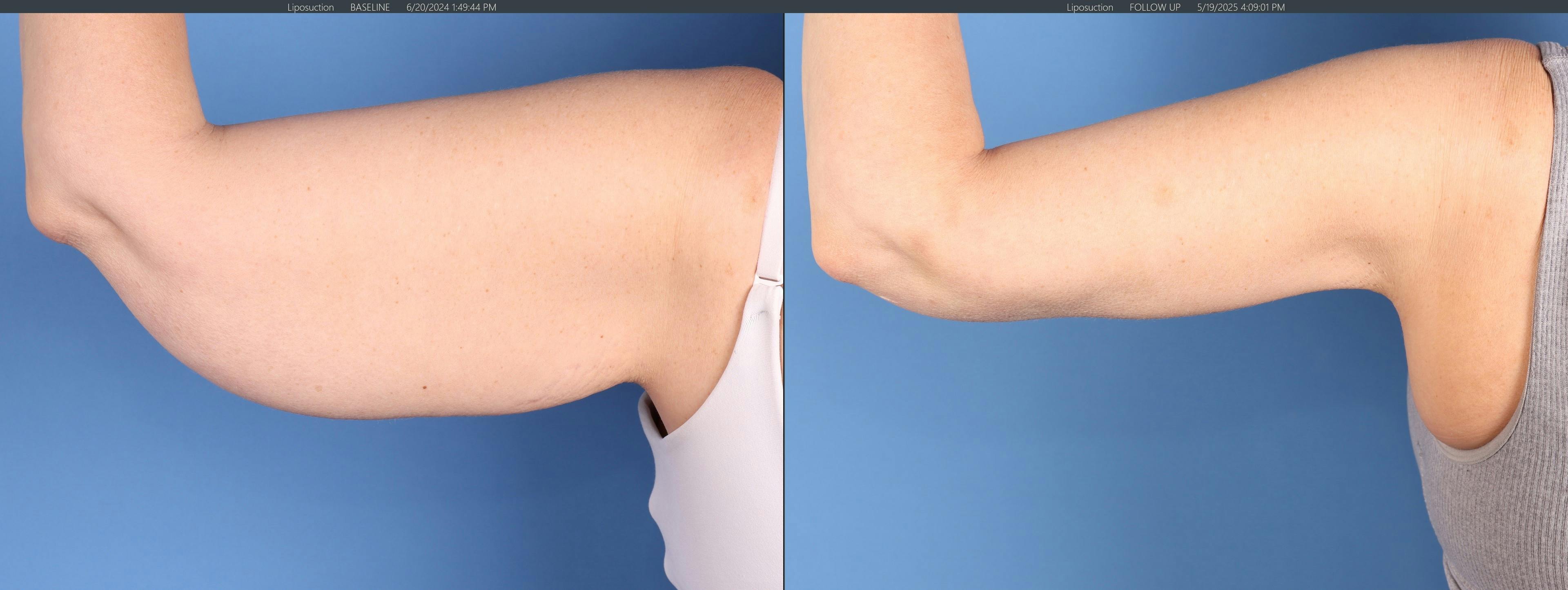 Arm Lift Before & After Gallery - Patient 308731 - Image 1