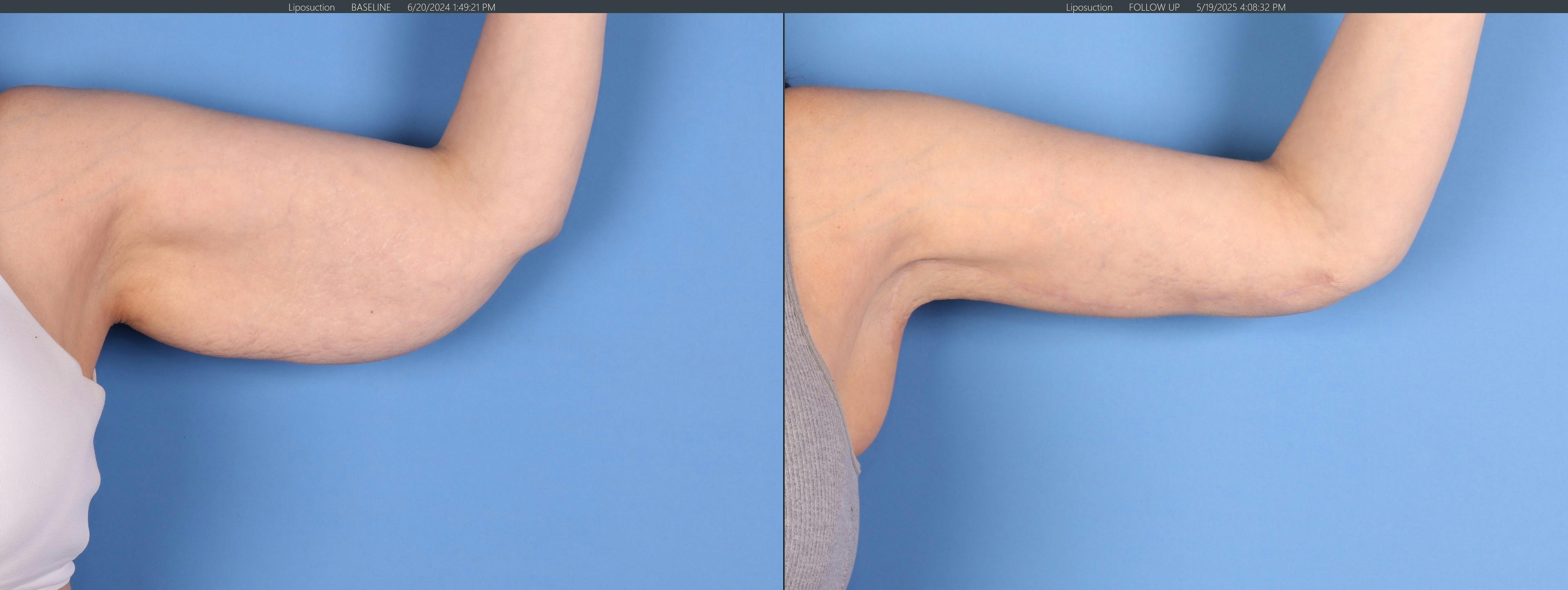 Arm Lift Before & After Gallery - Patient 308731 - Image 2