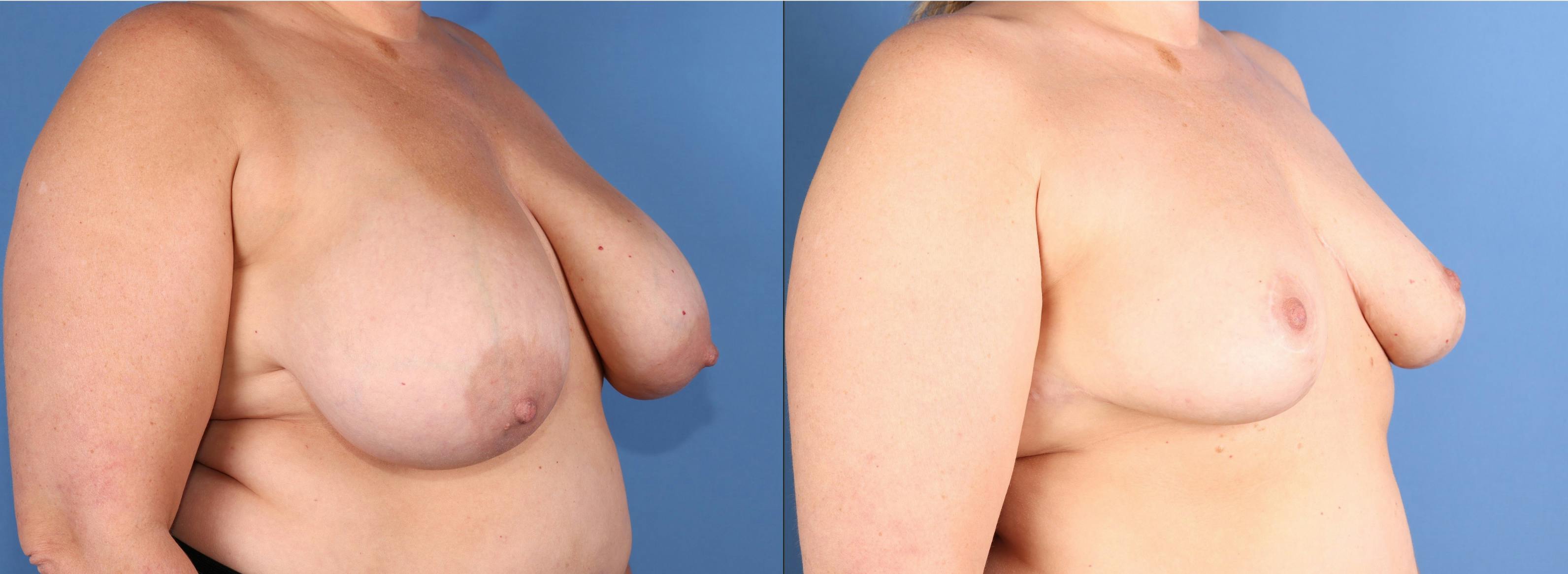Breast Reduction Before & After Gallery - Patient 197268 - Image 2