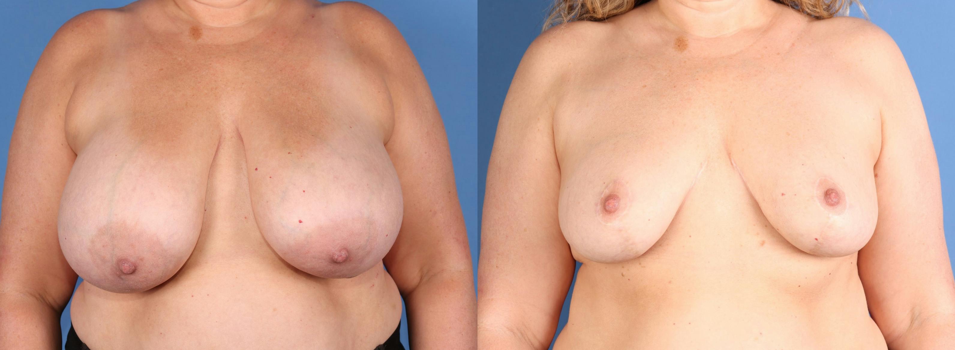 Breast Reduction Before & After Gallery - Patient 197268 - Image 1