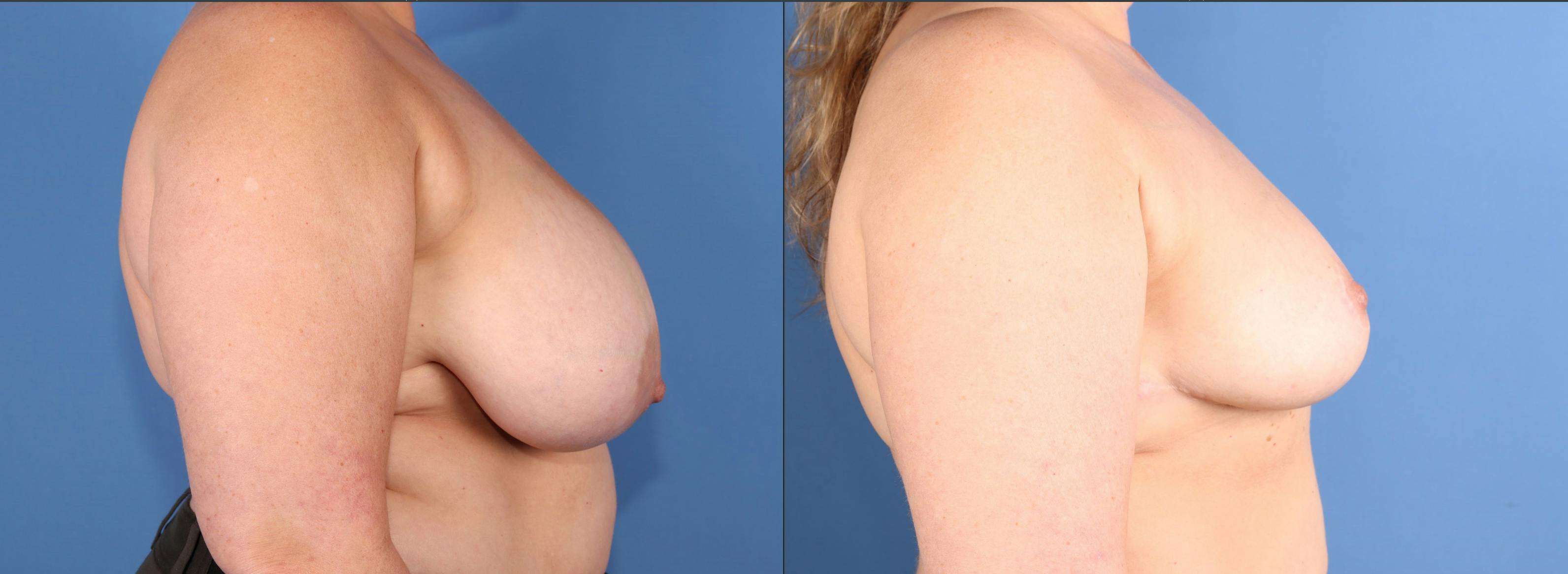 Breast Reduction Before & After Gallery - Patient 197268 - Image 3