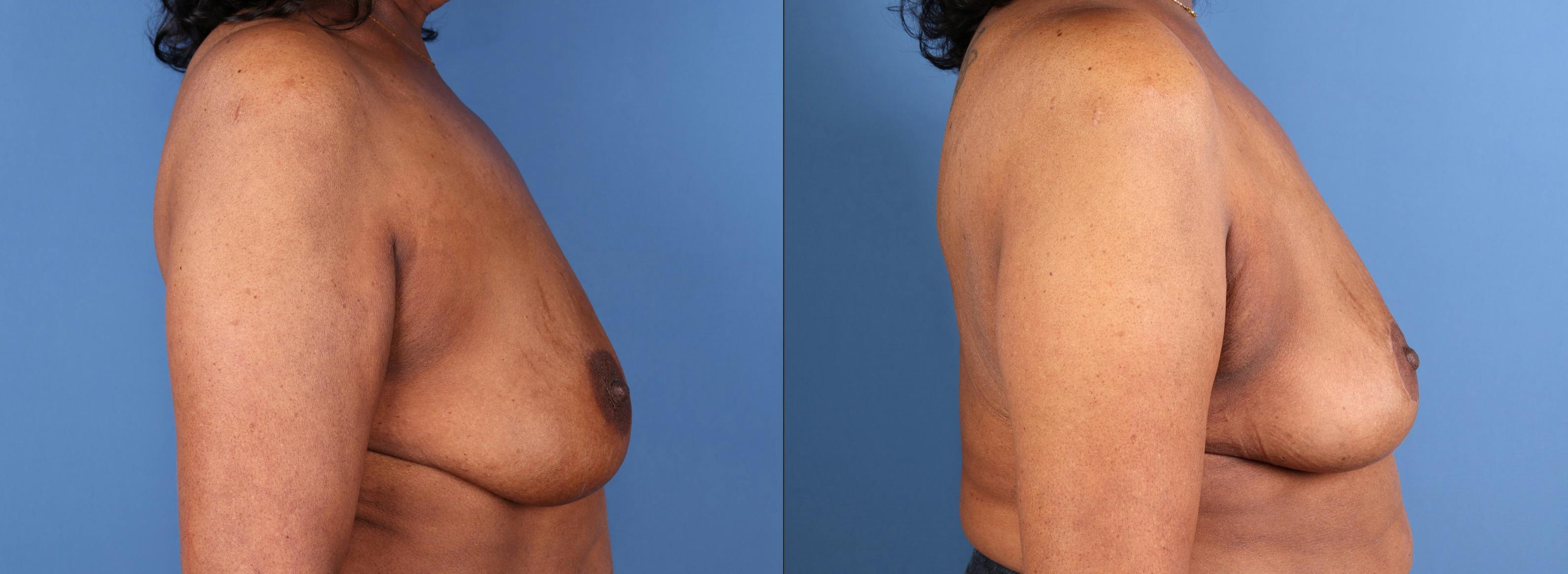 Breast Lift Before & After Gallery - Patient 289626 - Image 3